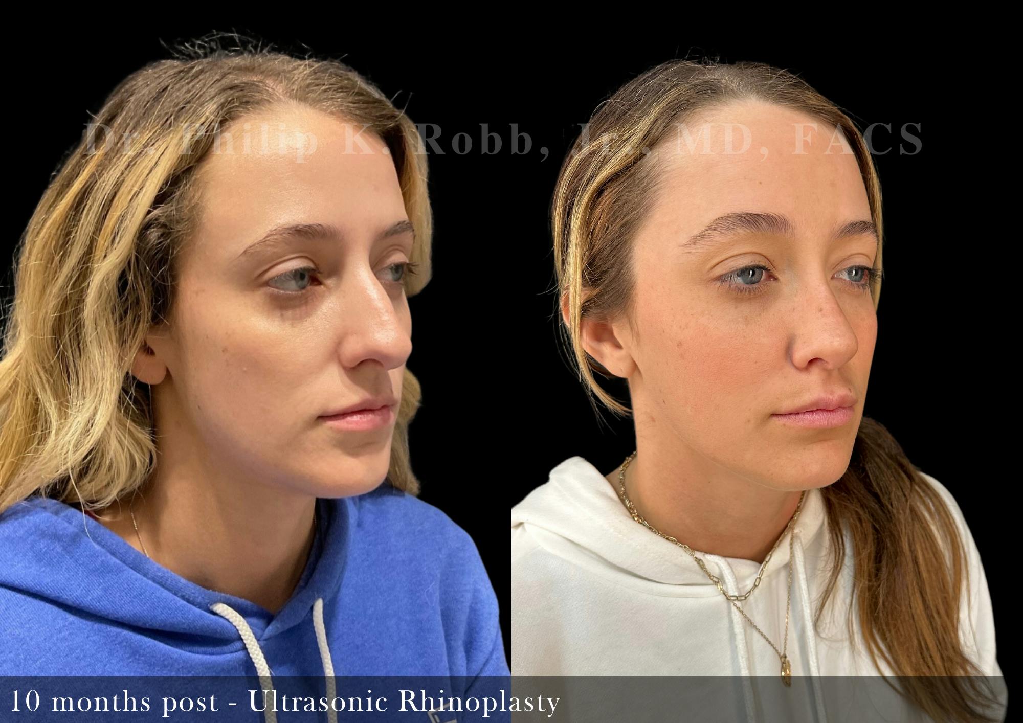 Nose Before & After Gallery - Patient 206361386 - Image 2