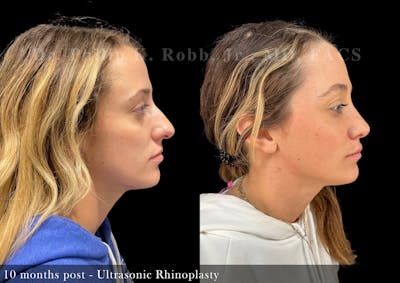 Nose Before & After Gallery - Patient 206361386 - Image 1