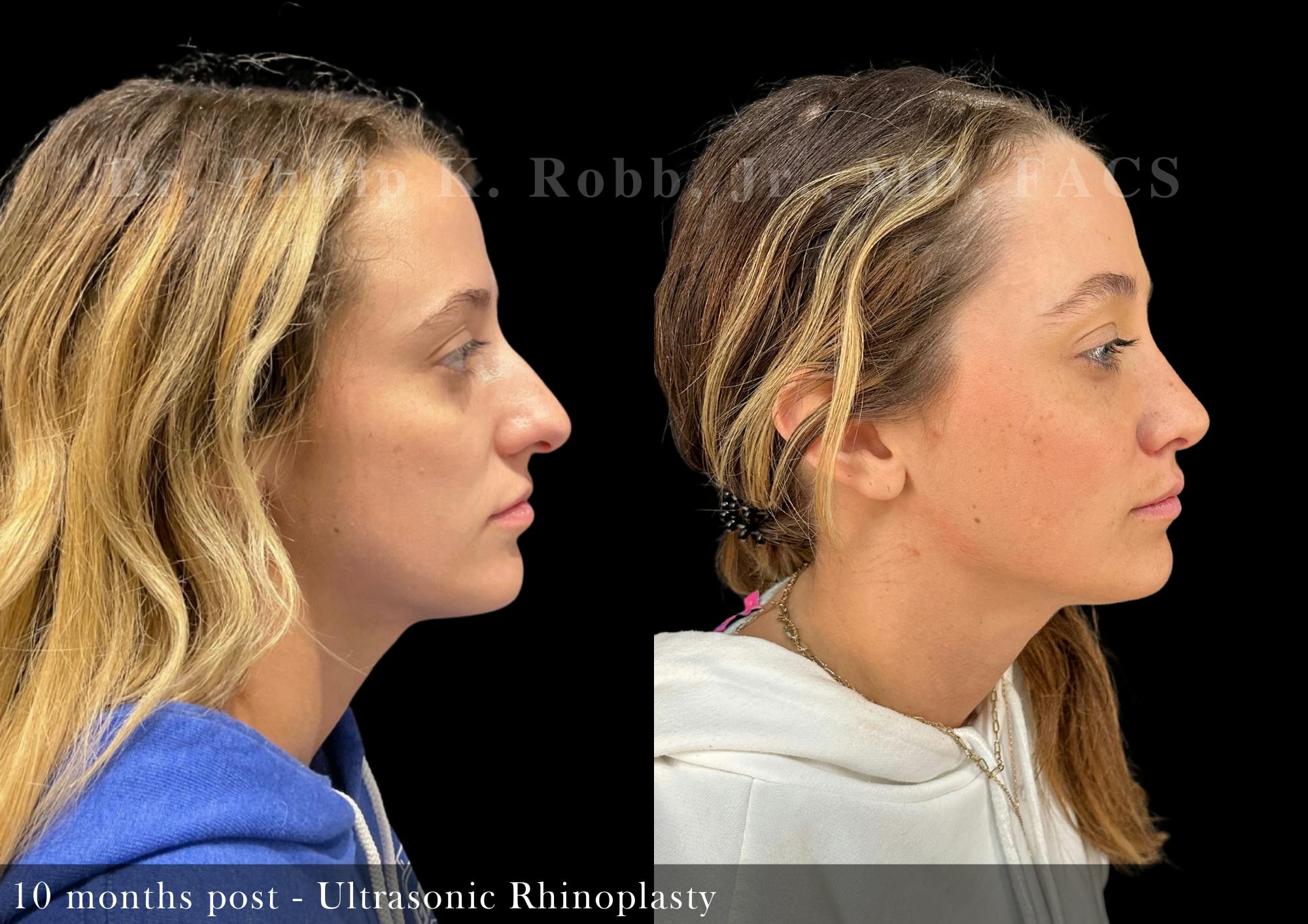 Nose Before & After Gallery - Patient 206361386 - Image 1