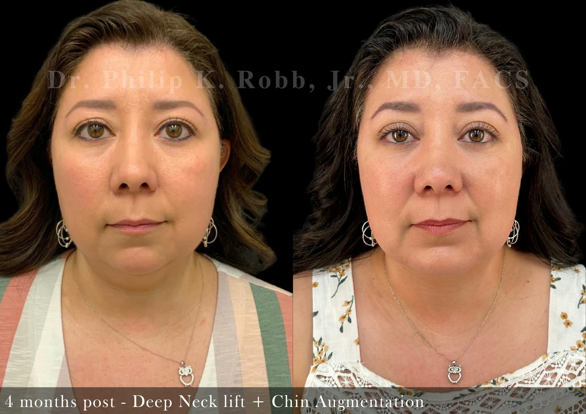 Face Before & After Gallery - Patient 205240729 - Image 1