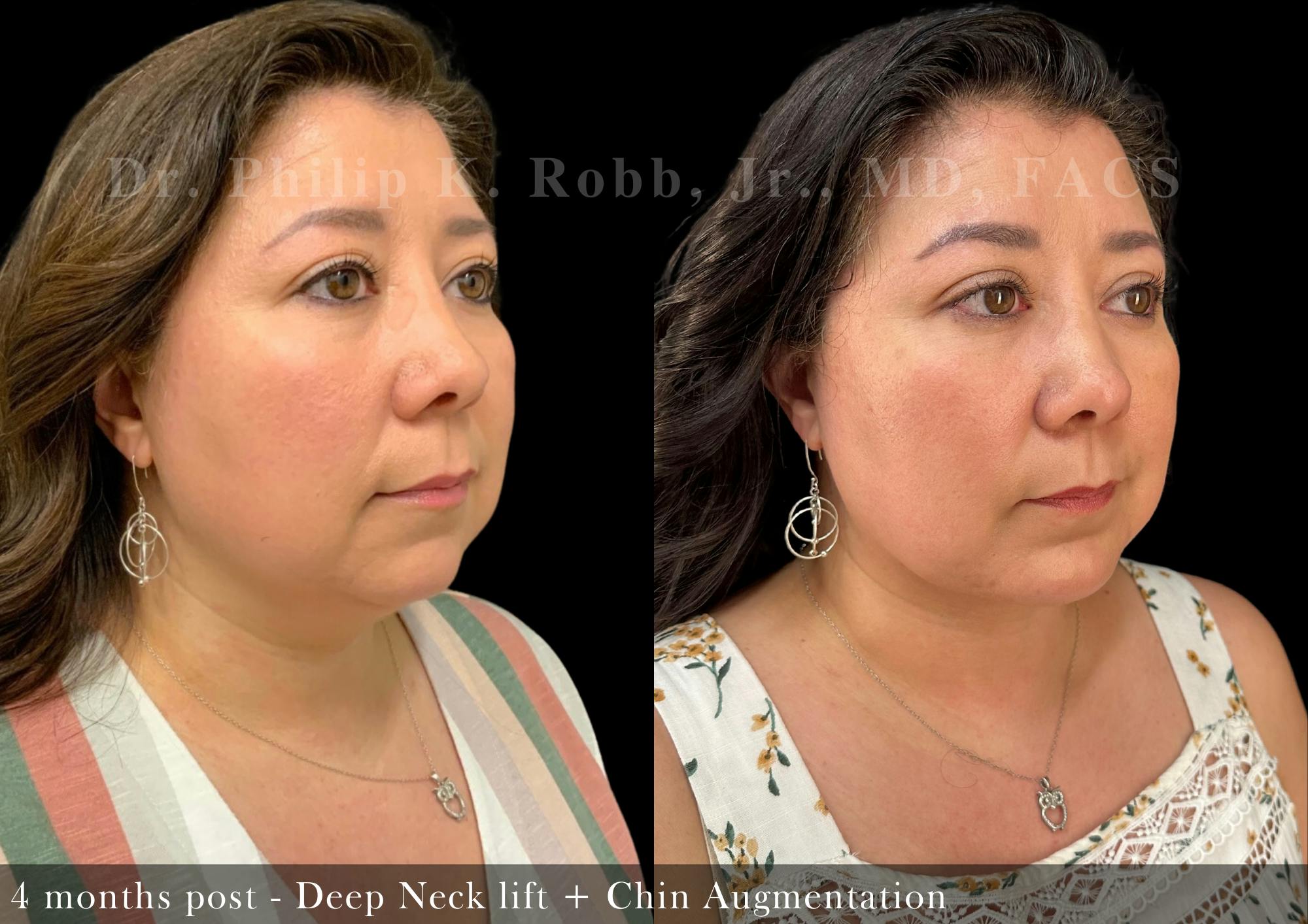 Face Before & After Gallery - Patient 205240729 - Image 2