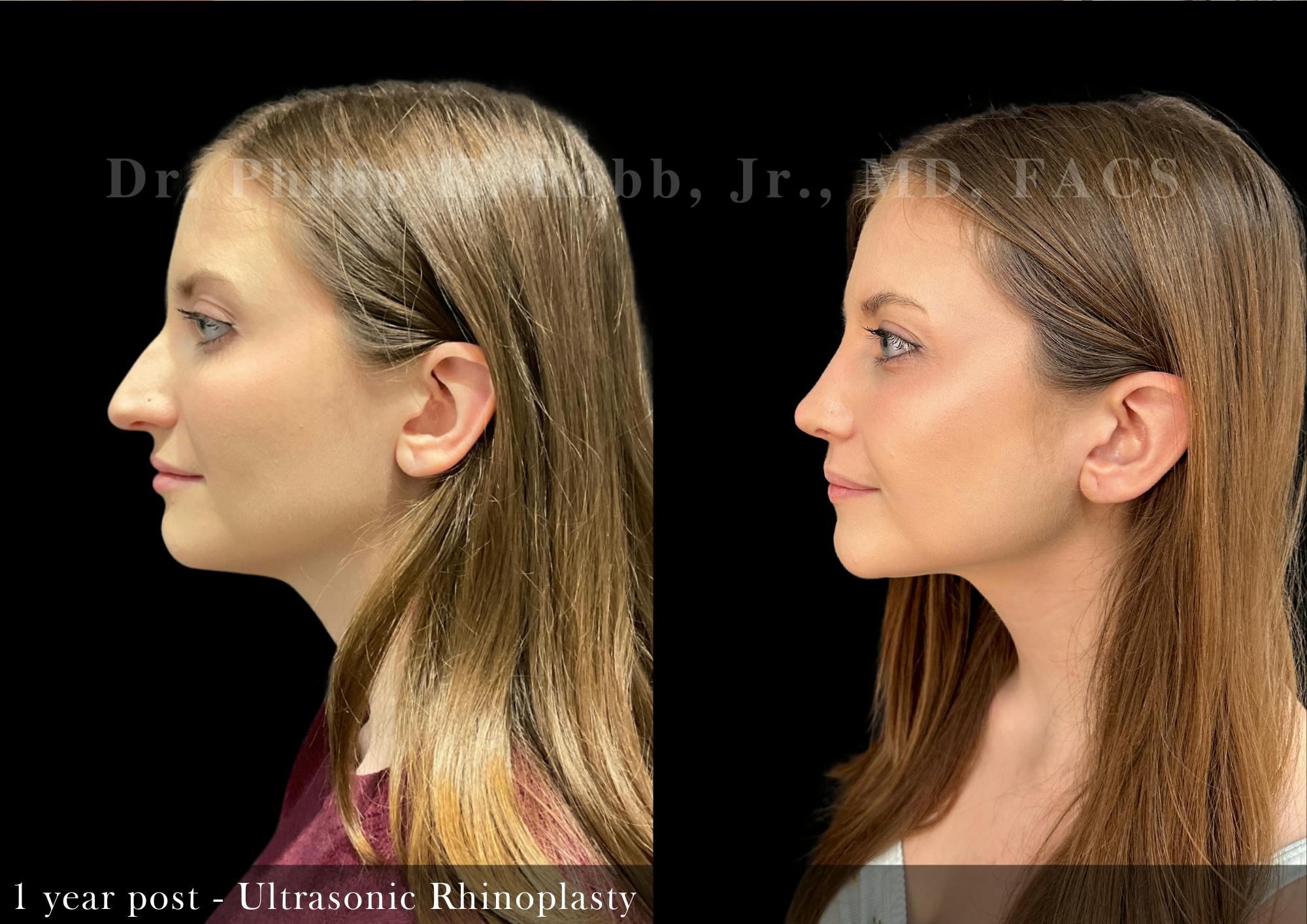 Nose Before & After Gallery - Patient 206361461 - Image 4