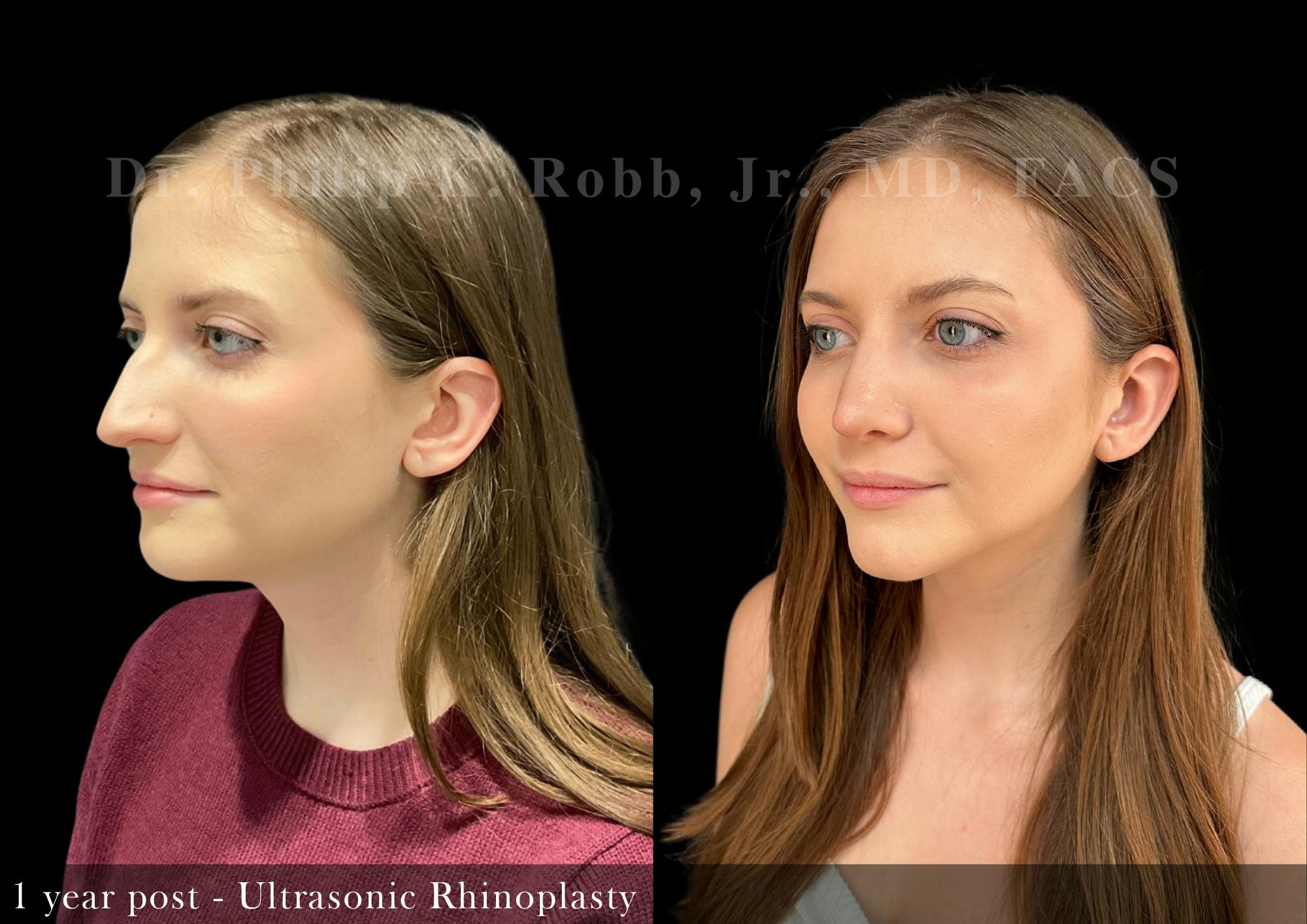 Nose Before & After Gallery - Patient 206361461 - Image 5