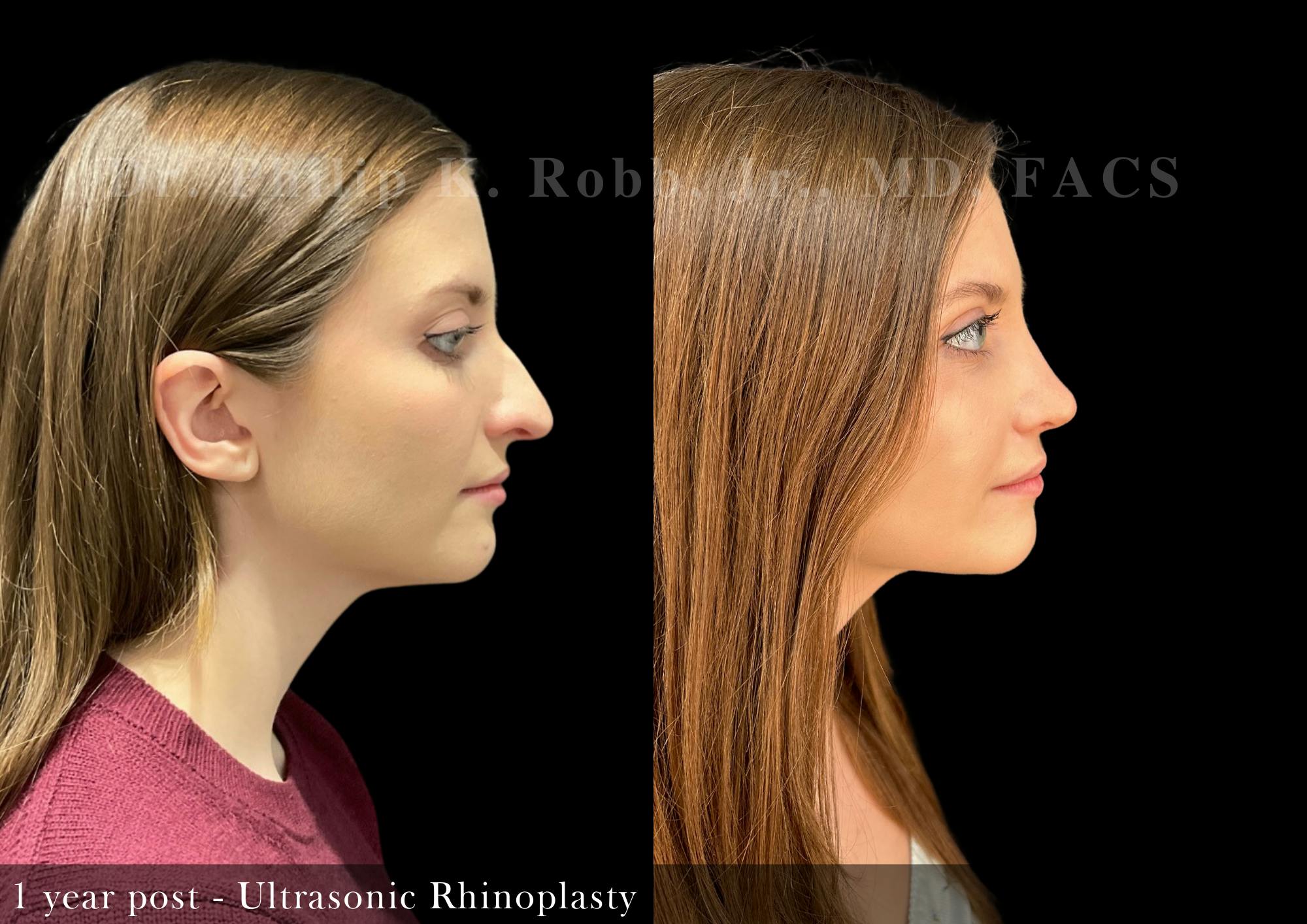 Nose Before & After Gallery - Patient 206361461 - Image 1