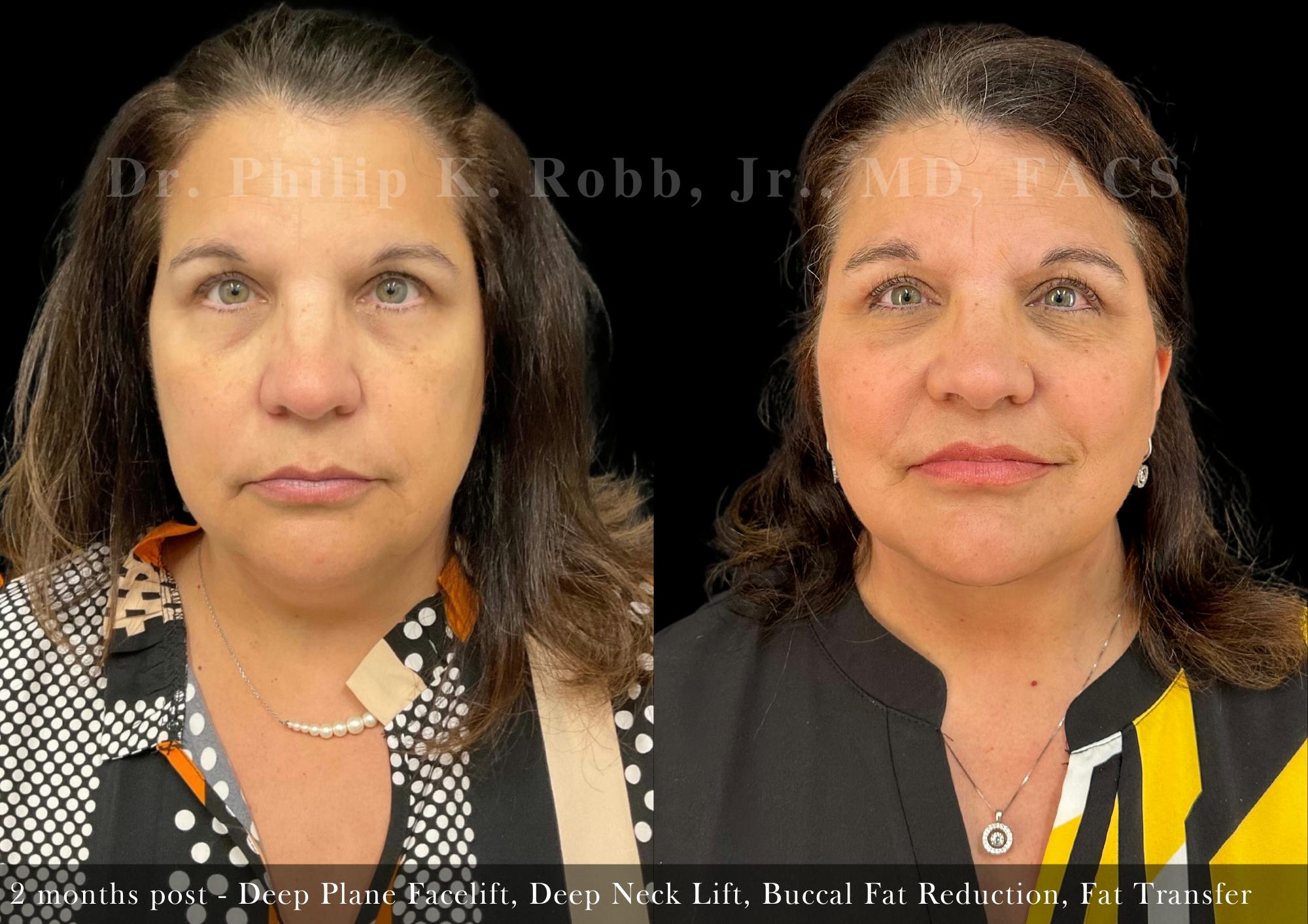 Face Before & After Gallery - Patient 205246697 - Image 1