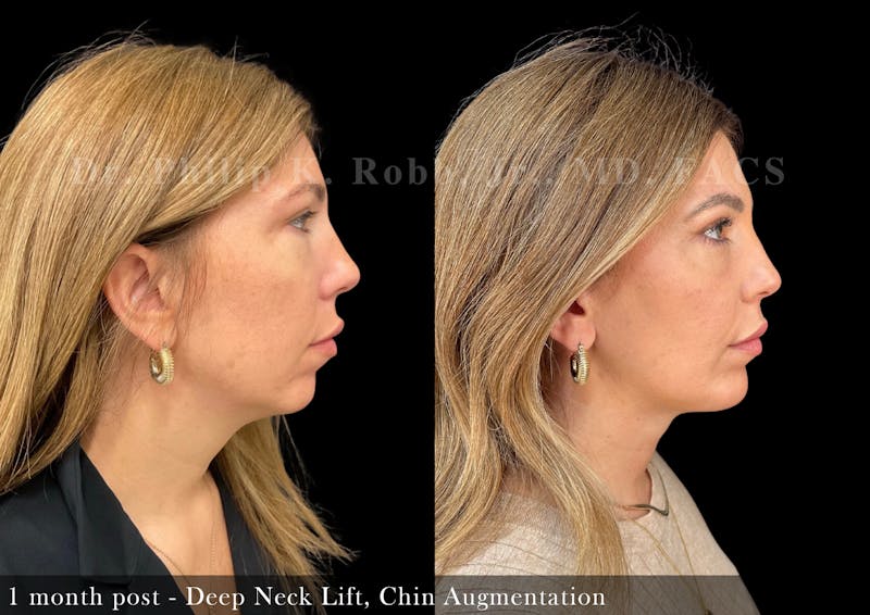 Face Before & After Gallery - Patient 205246736 - Image 1