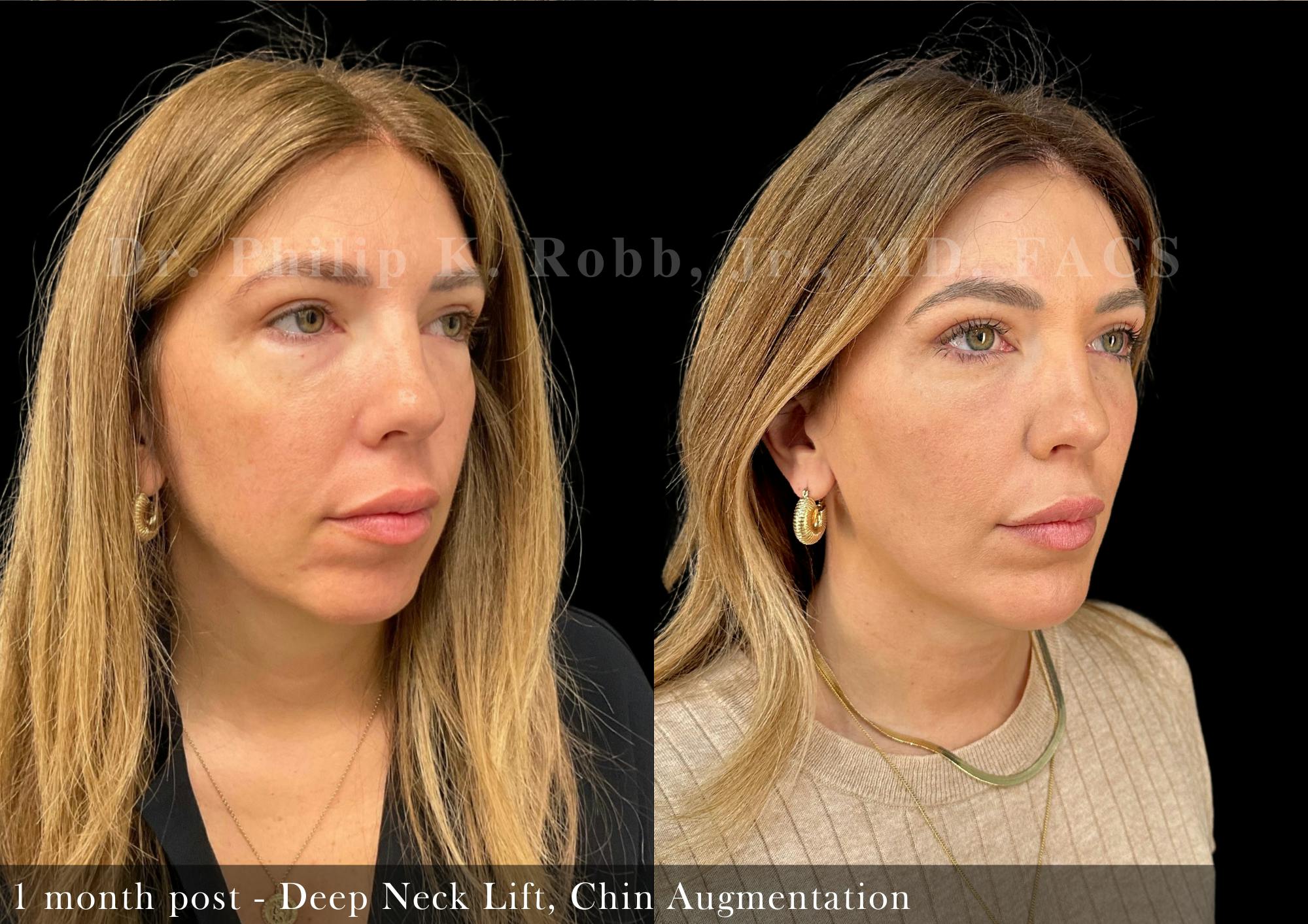 Face Before & After Gallery - Patient 205246736 - Image 2