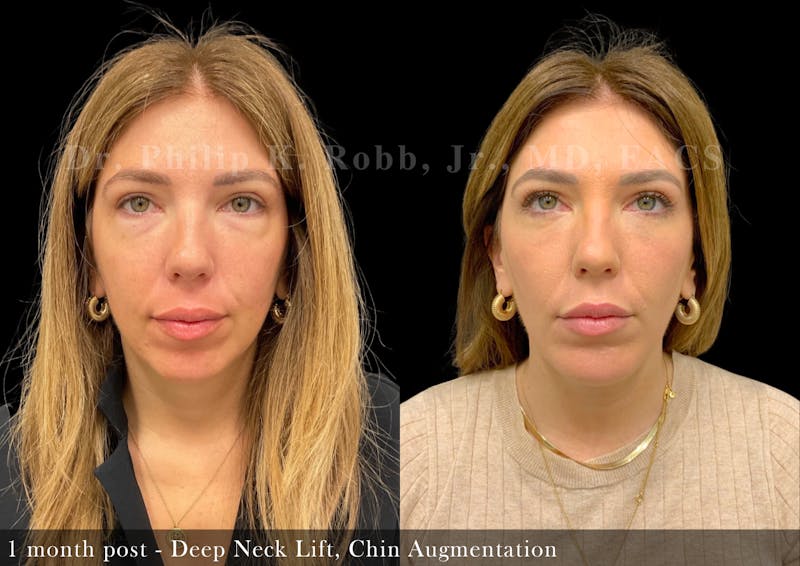 Face Before & After Gallery - Patient 205246736 - Image 3