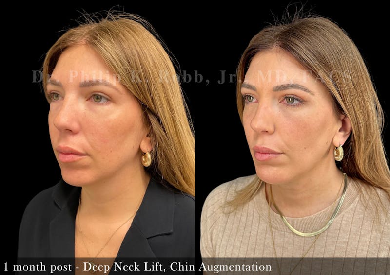 Face Before & After Gallery - Patient 205246736 - Image 4