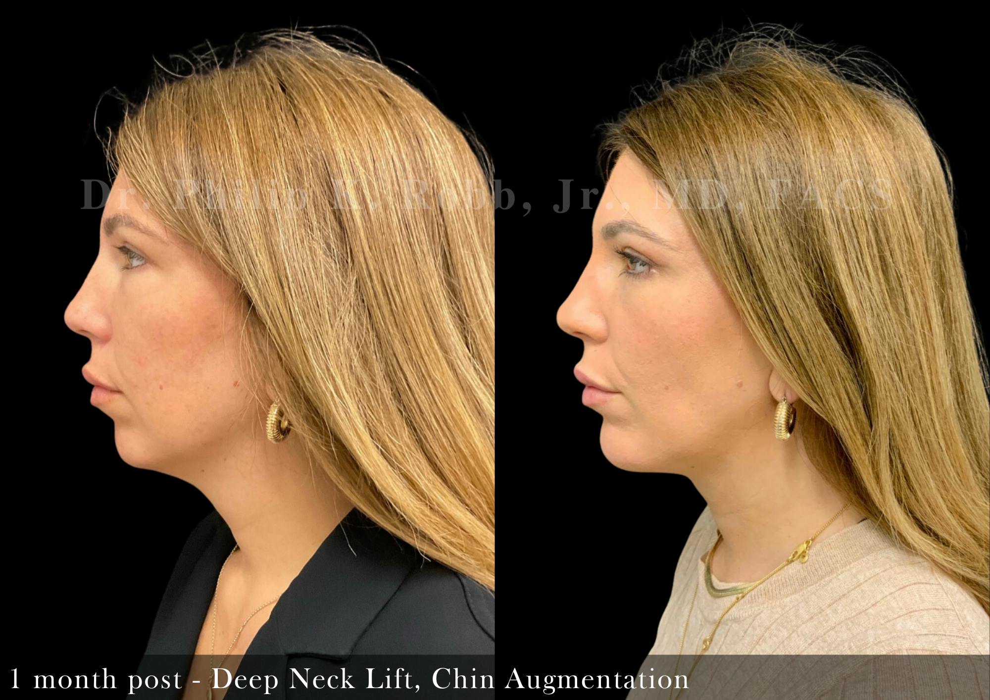 Face Before & After Gallery - Patient 205246736 - Image 5