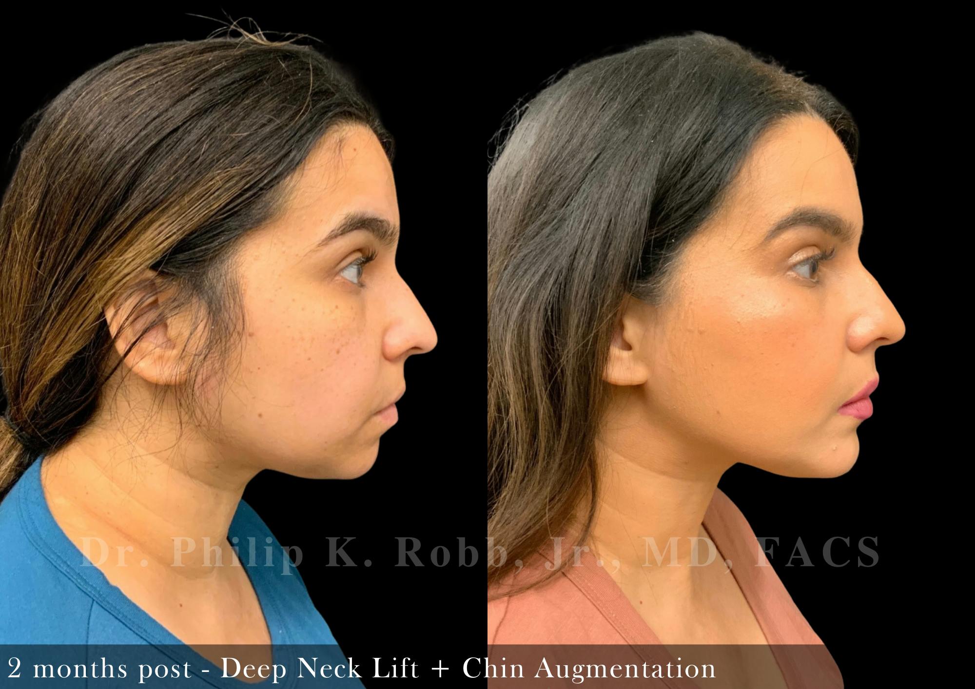 Face Before & After Gallery - Patient 206305968 - Image 3