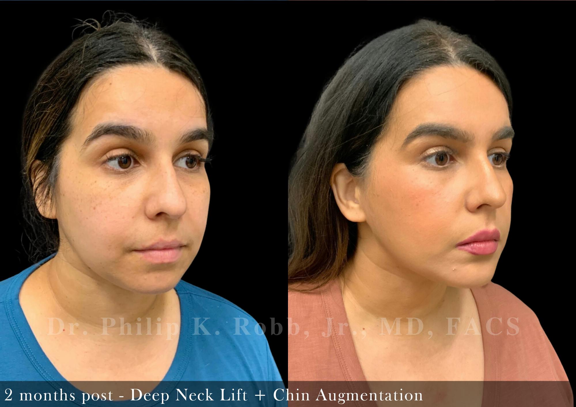 Face Before & After Gallery - Patient 206305968 - Image 2