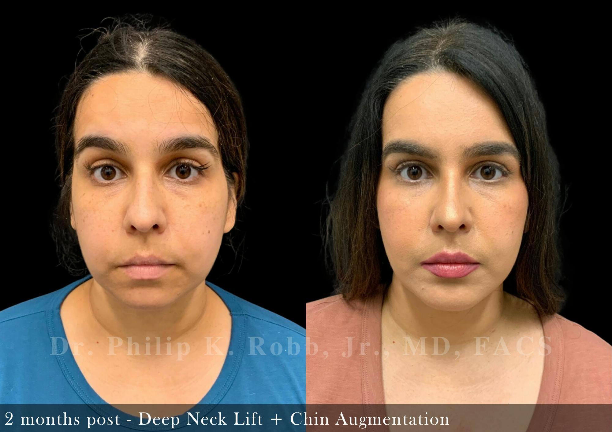 Face Before & After Gallery - Patient 206305968 - Image 1