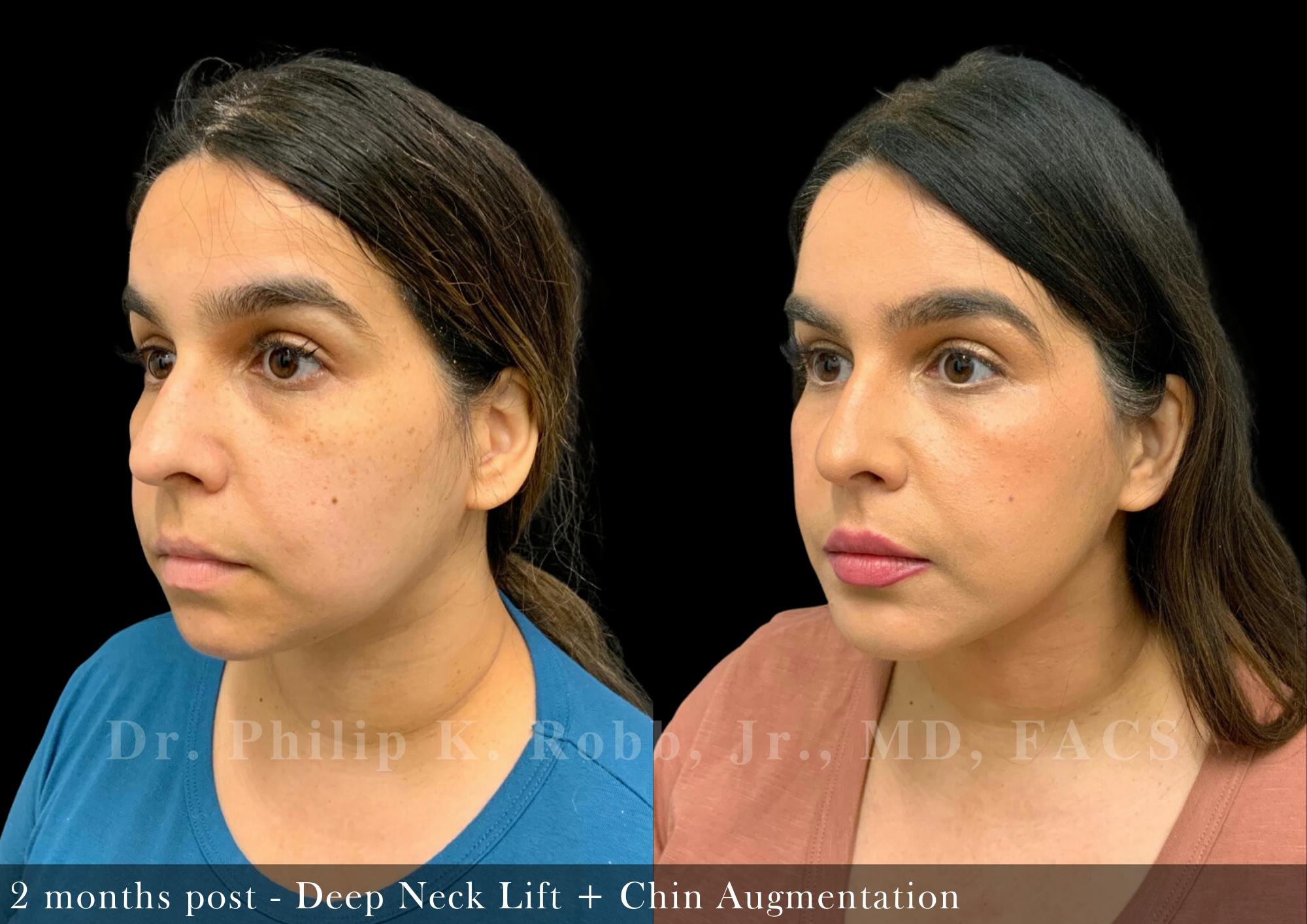 Face Before & After Gallery - Patient 206305968 - Image 4