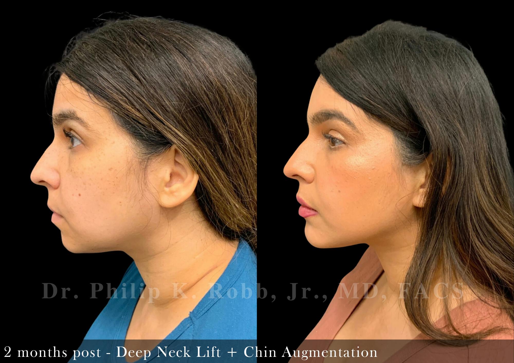 Face Before & After Gallery - Patient 206305968 - Image 5