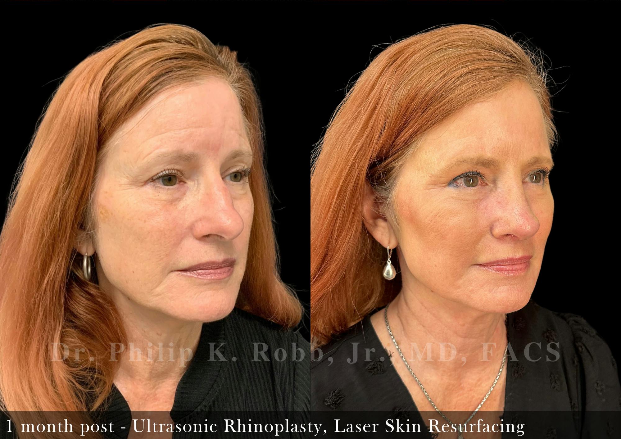 Nose Before & After Gallery - Patient 205214435 - Image 2