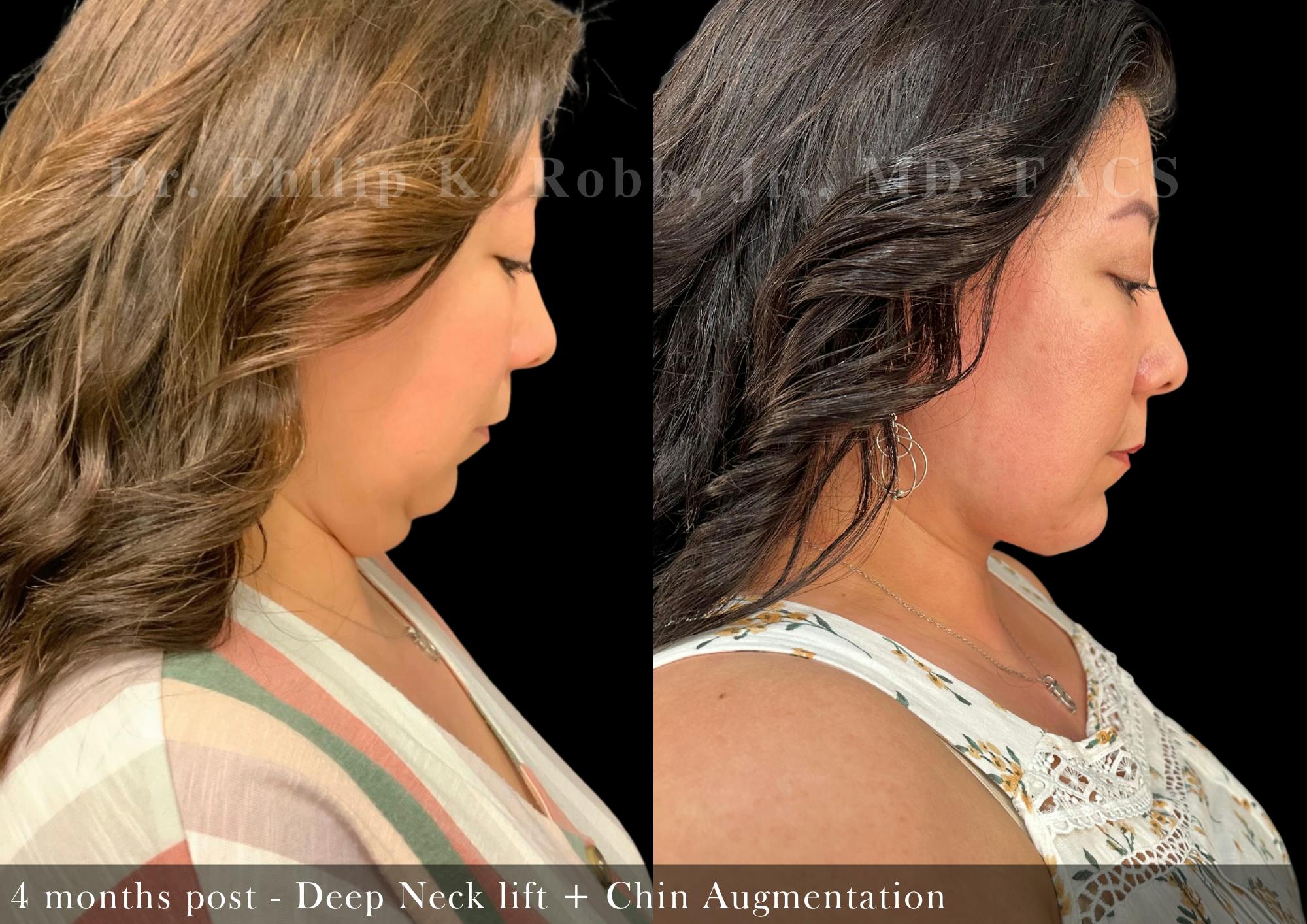 Face Before & After Gallery - Patient 205240729 - Image 6