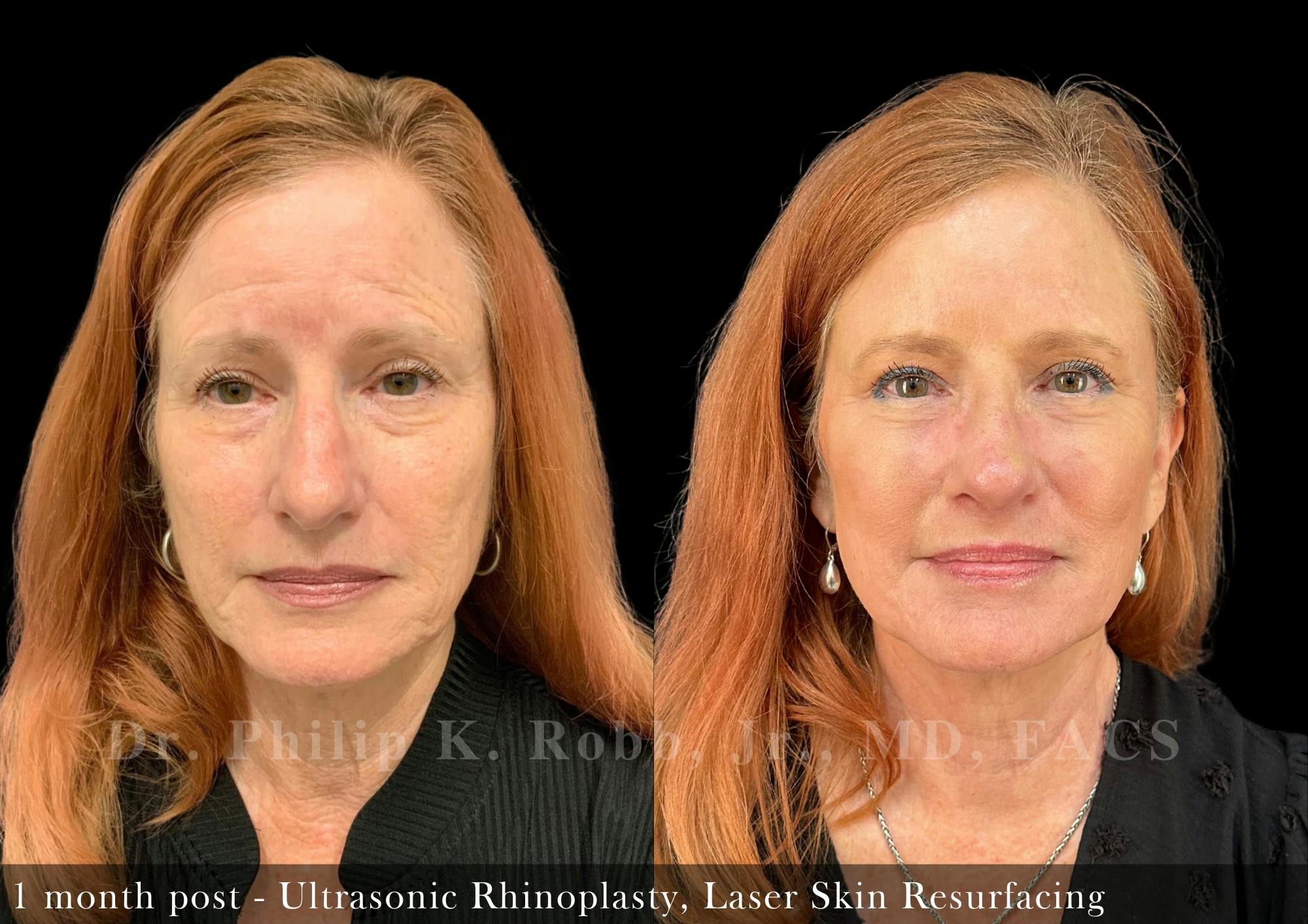 Nose Before & After Gallery - Patient 205214435 - Image 3