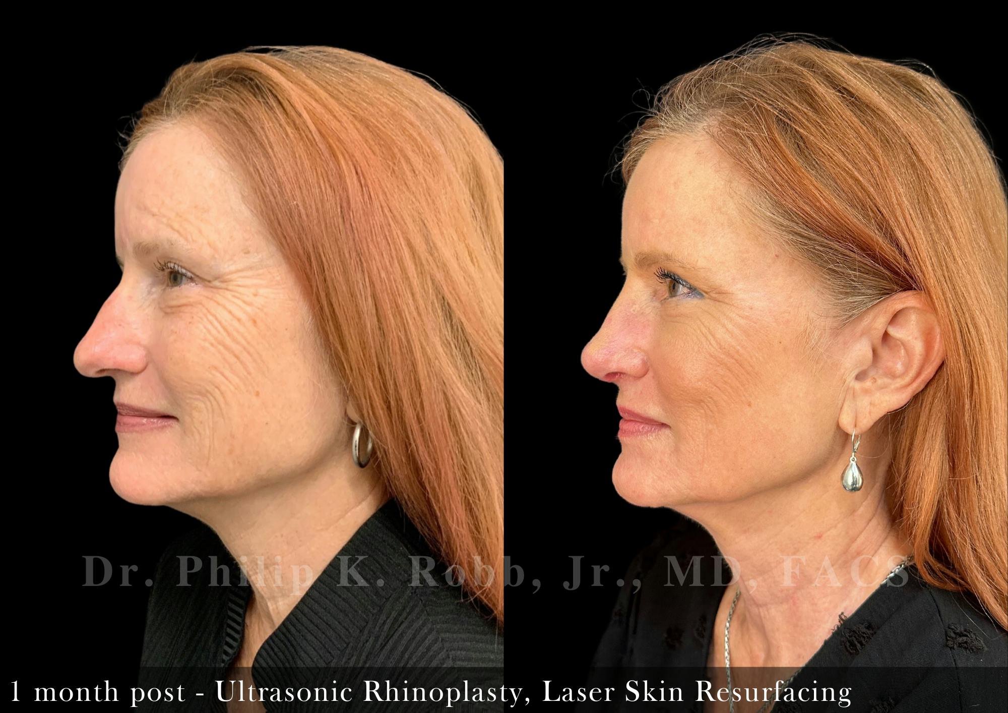 Non-Surgical Before & After Gallery - Patient 205217066 - Image 5