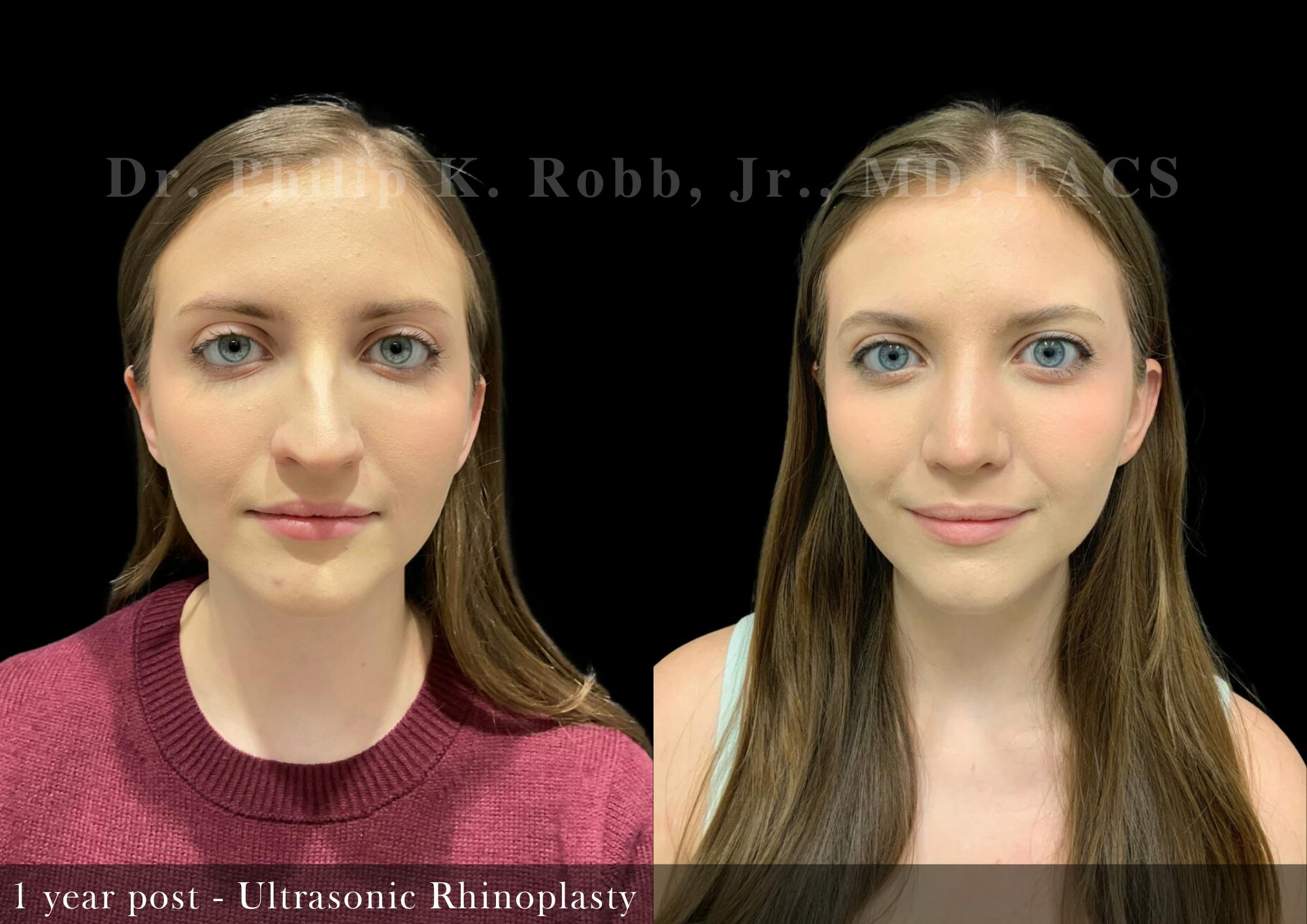 Nose Before & After Gallery - Patient 206361461 - Image 3