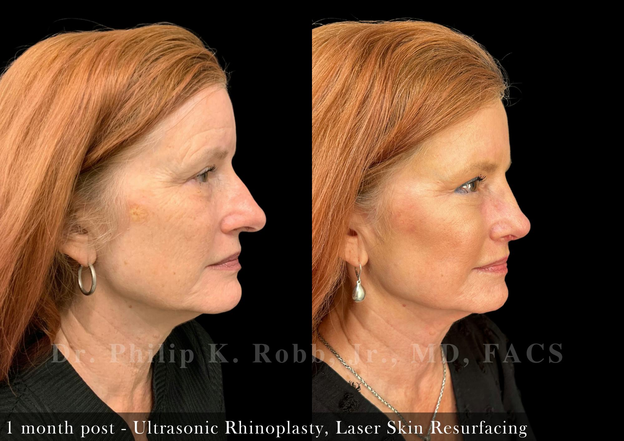 Nose Before & After Gallery - Patient 205214435 - Image 1