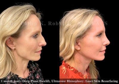 Nose Before & After Gallery - Patient 205214439 - Image 1