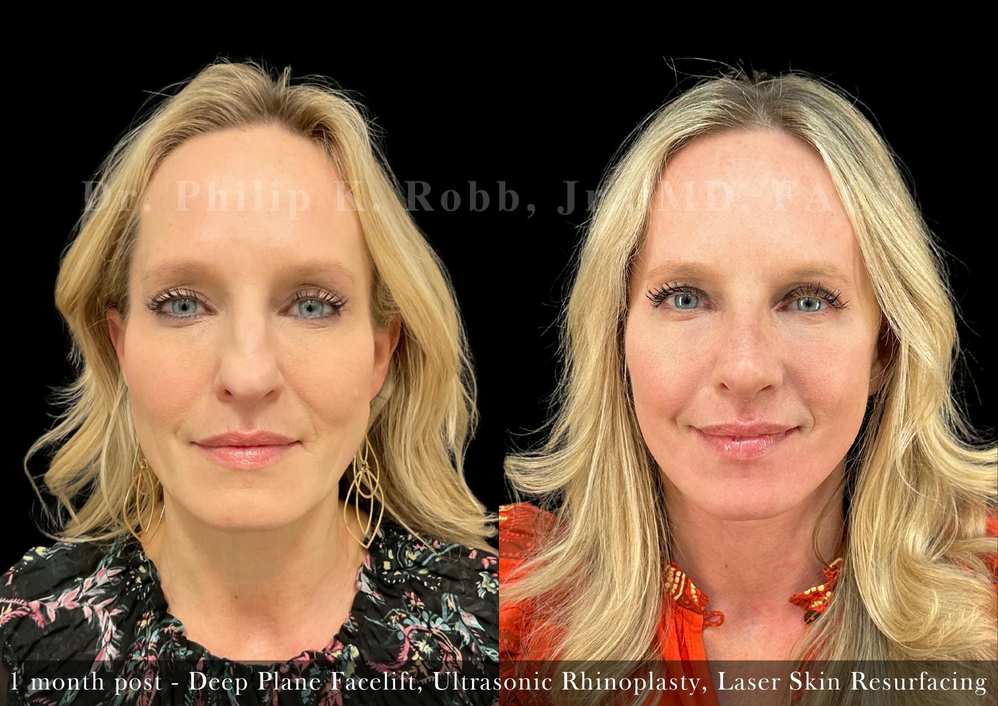 Nose Before & After Gallery - Patient 205214439 - Image 3