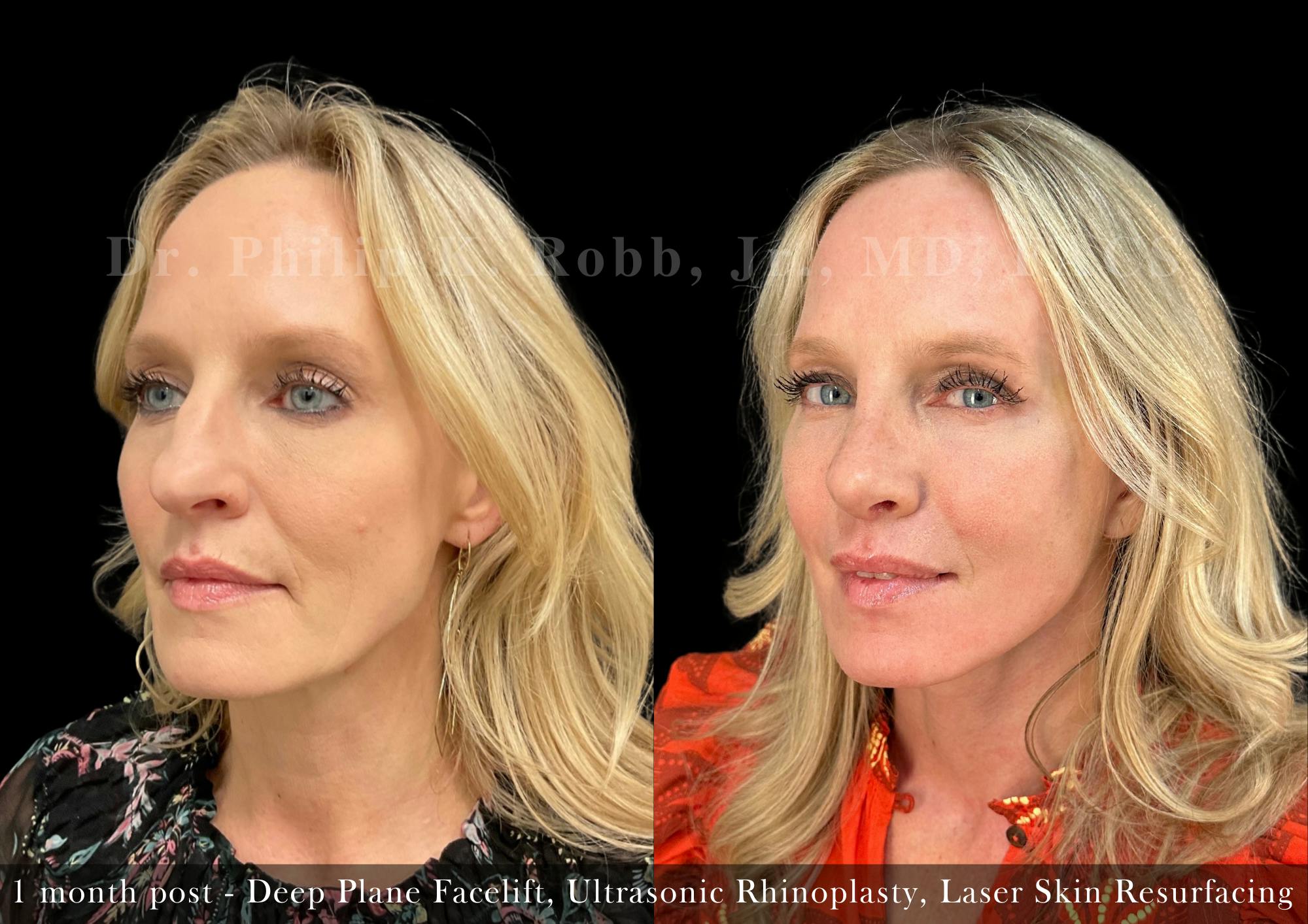 Nose Before & After Gallery - Patient 205214439 - Image 4