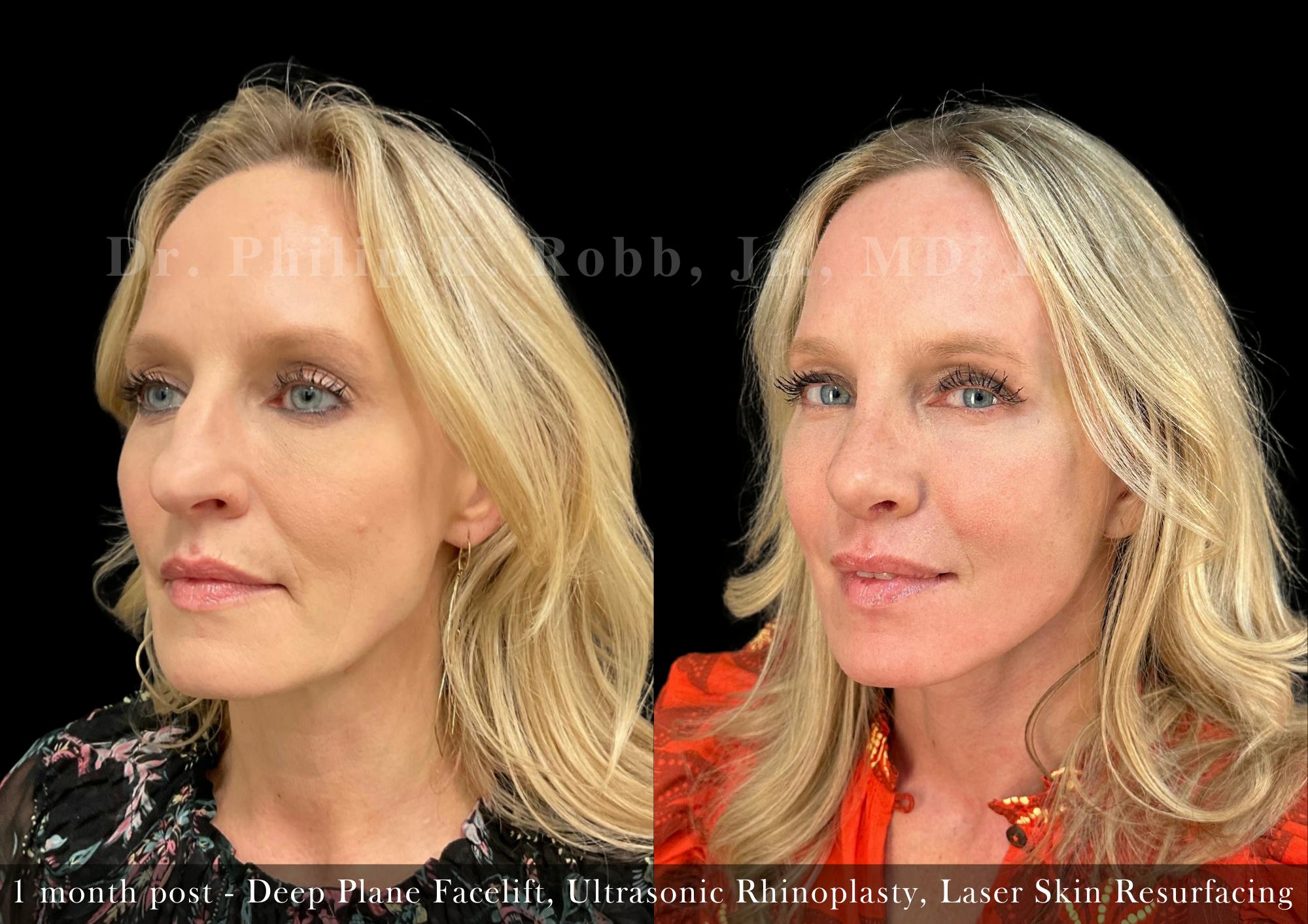 Non-Surgical Before & After Gallery - Patient 205217065 - Image 4
