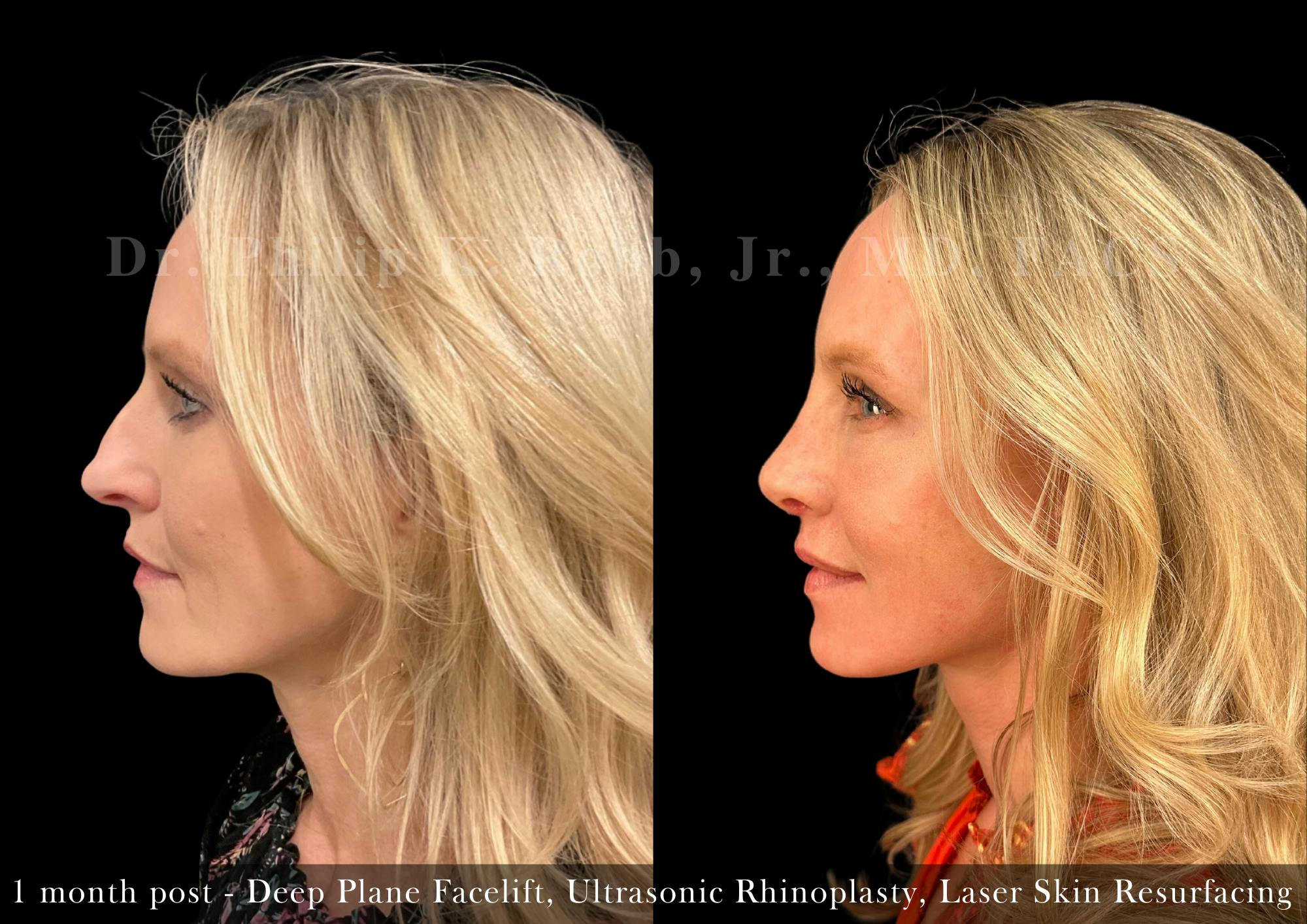 Nose Before & After Gallery - Patient 205214439 - Image 5