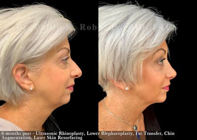 Nose Before & After Gallery - Patient 206656647 - Image 1