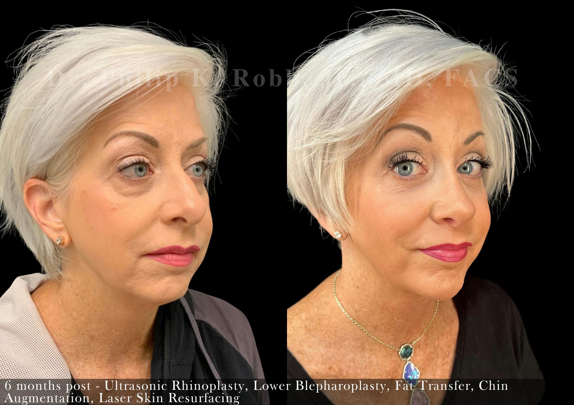 Nose Before & After Gallery - Patient 206656647 - Image 2
