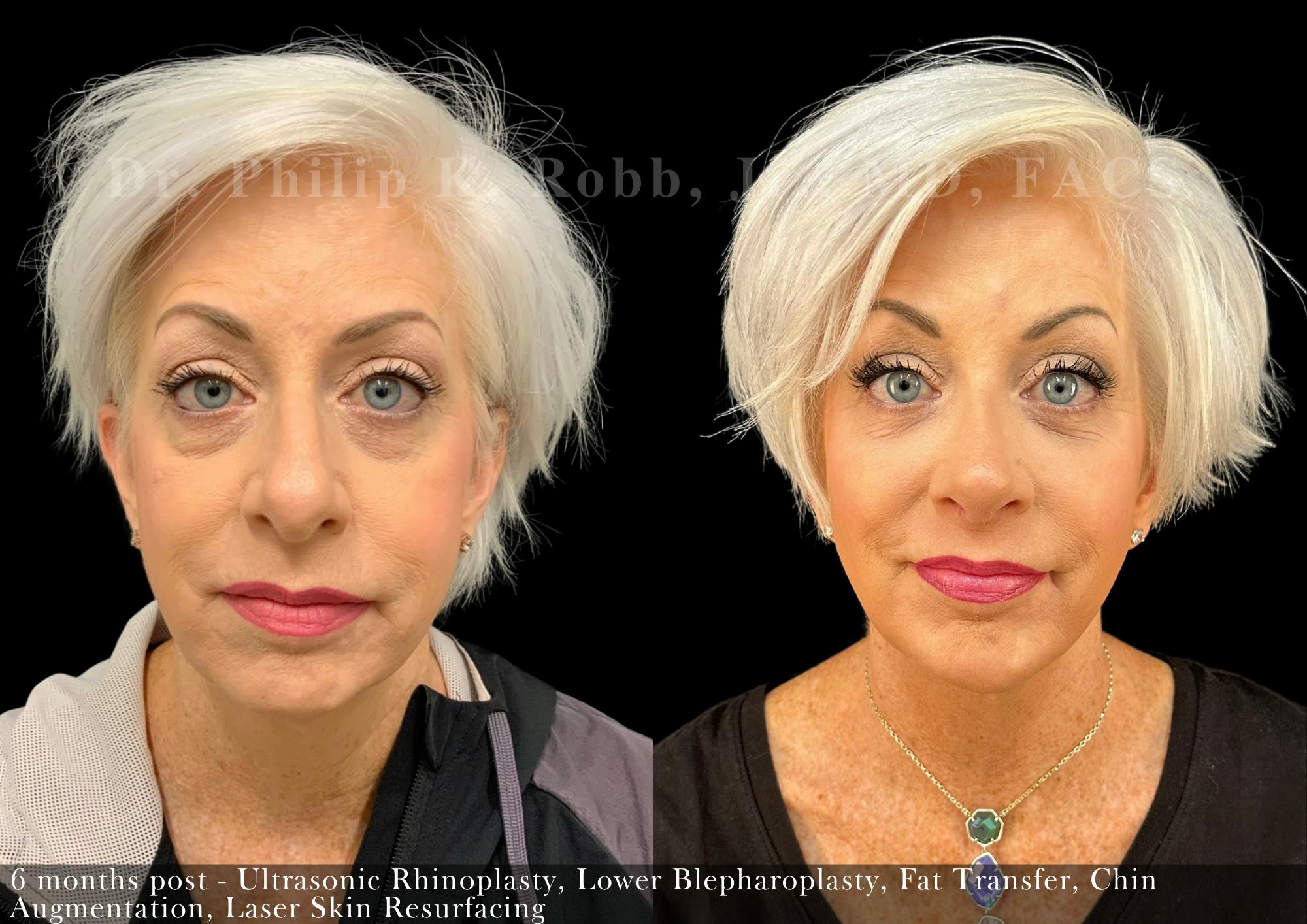Nose Before & After Gallery - Patient 206656647 - Image 3