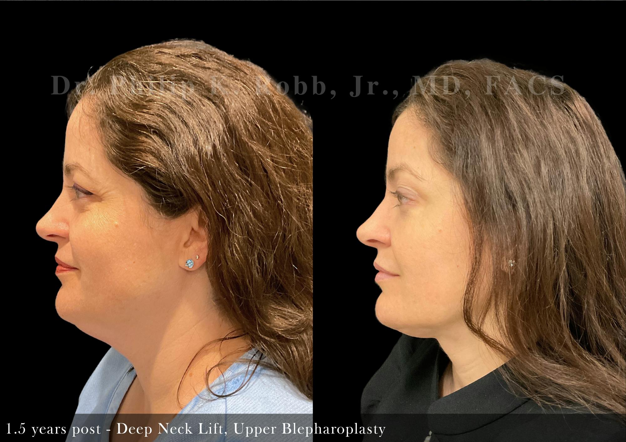 Face Before & After Gallery - Patient 206653326 - Image 5