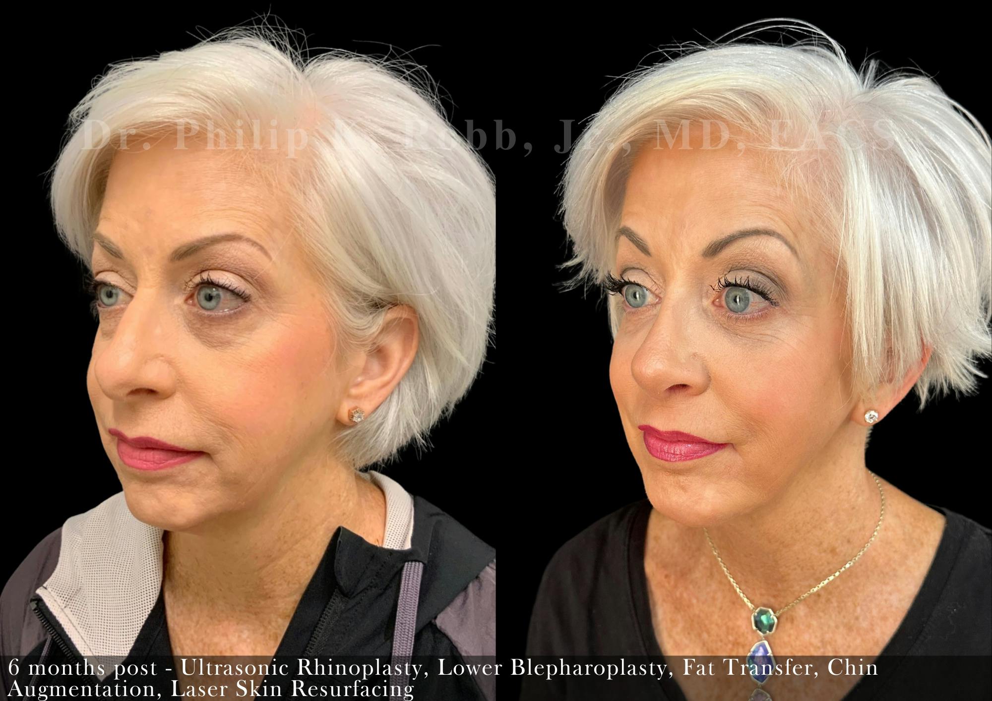 Face Before & After Gallery - Patient 206656631 - Image 4