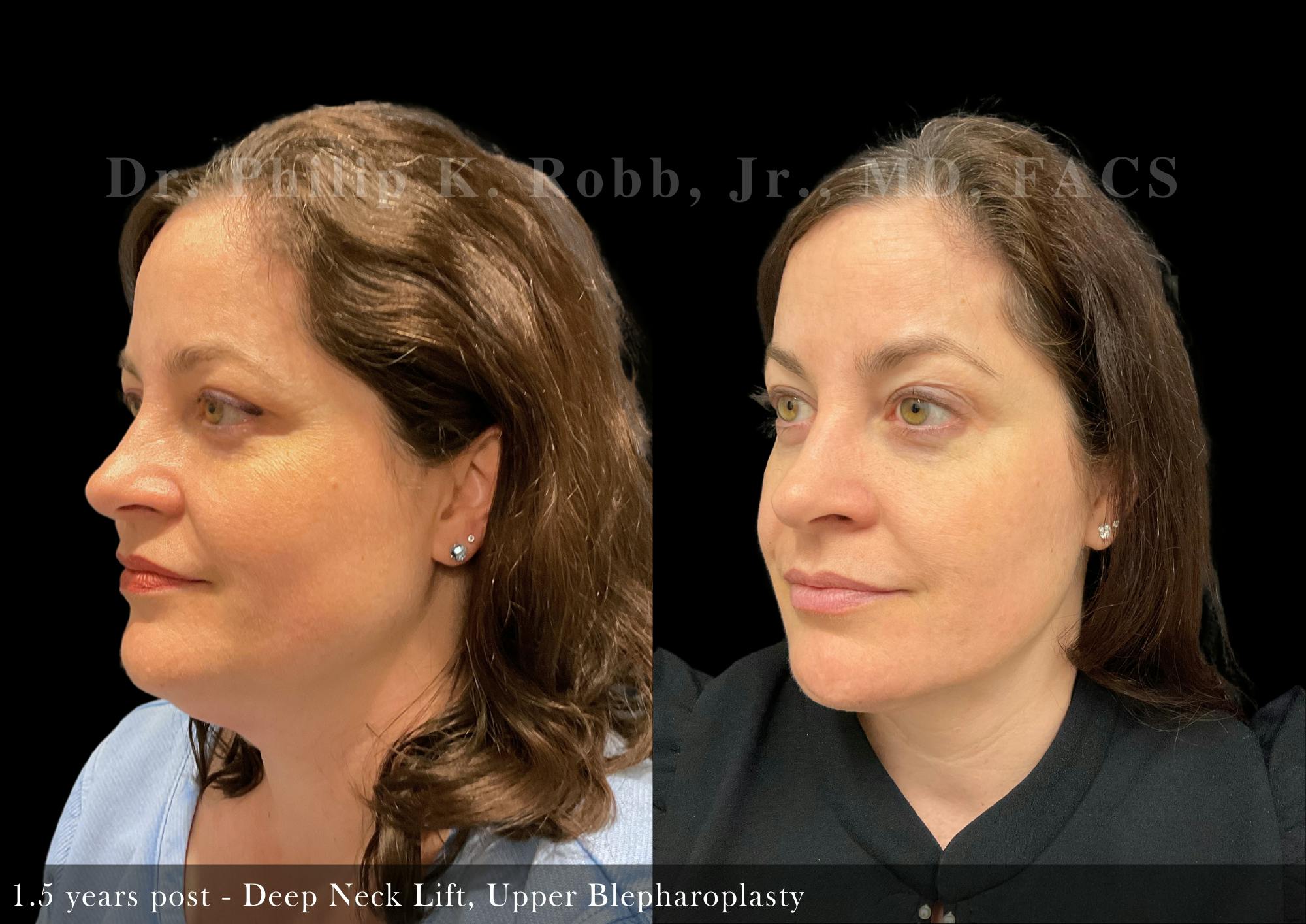 Face Before & After Gallery - Patient 206653326 - Image 4