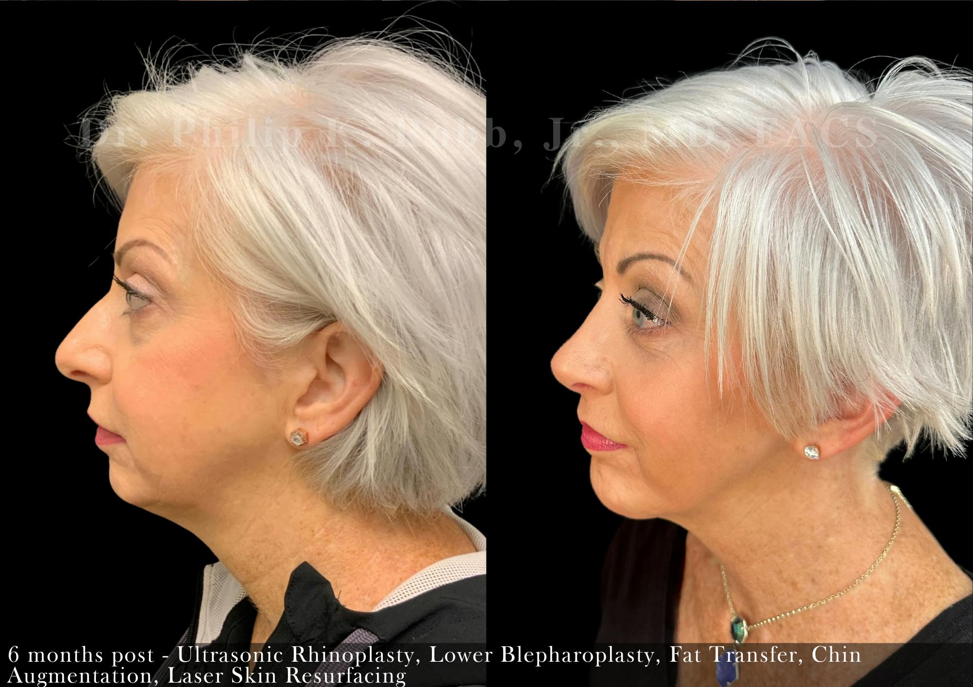 Nose Before & After Gallery - Patient 206656647 - Image 5