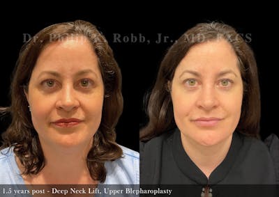 Face Before & After Gallery - Patient 206653326 - Image 1