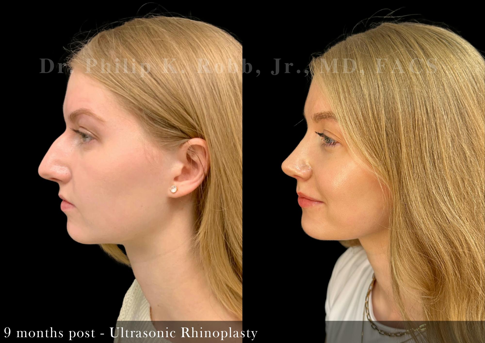 Nose Before & After Gallery - Patient 206656652 - Image 4