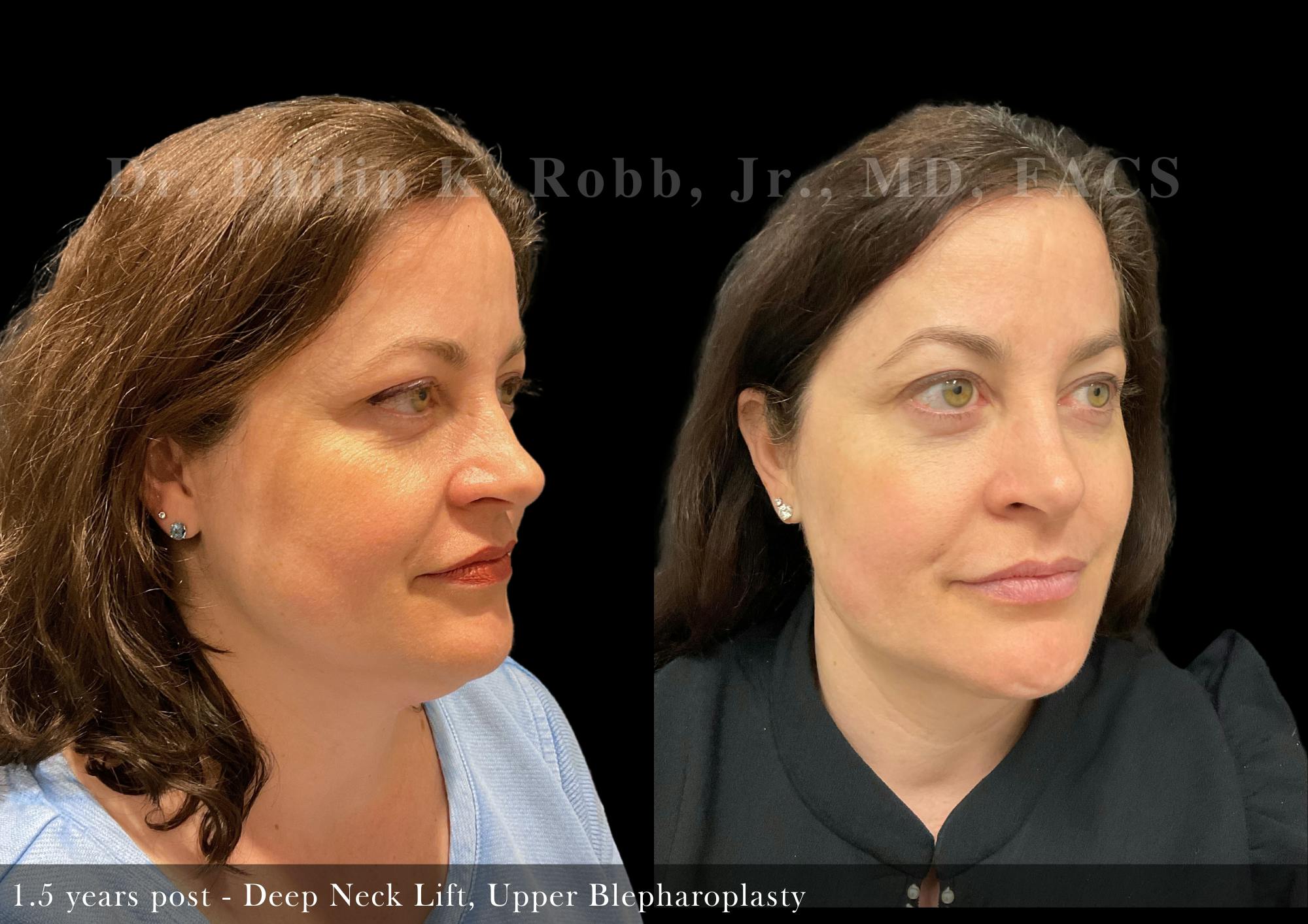 Face Before & After Gallery - Patient 206653326 - Image 2