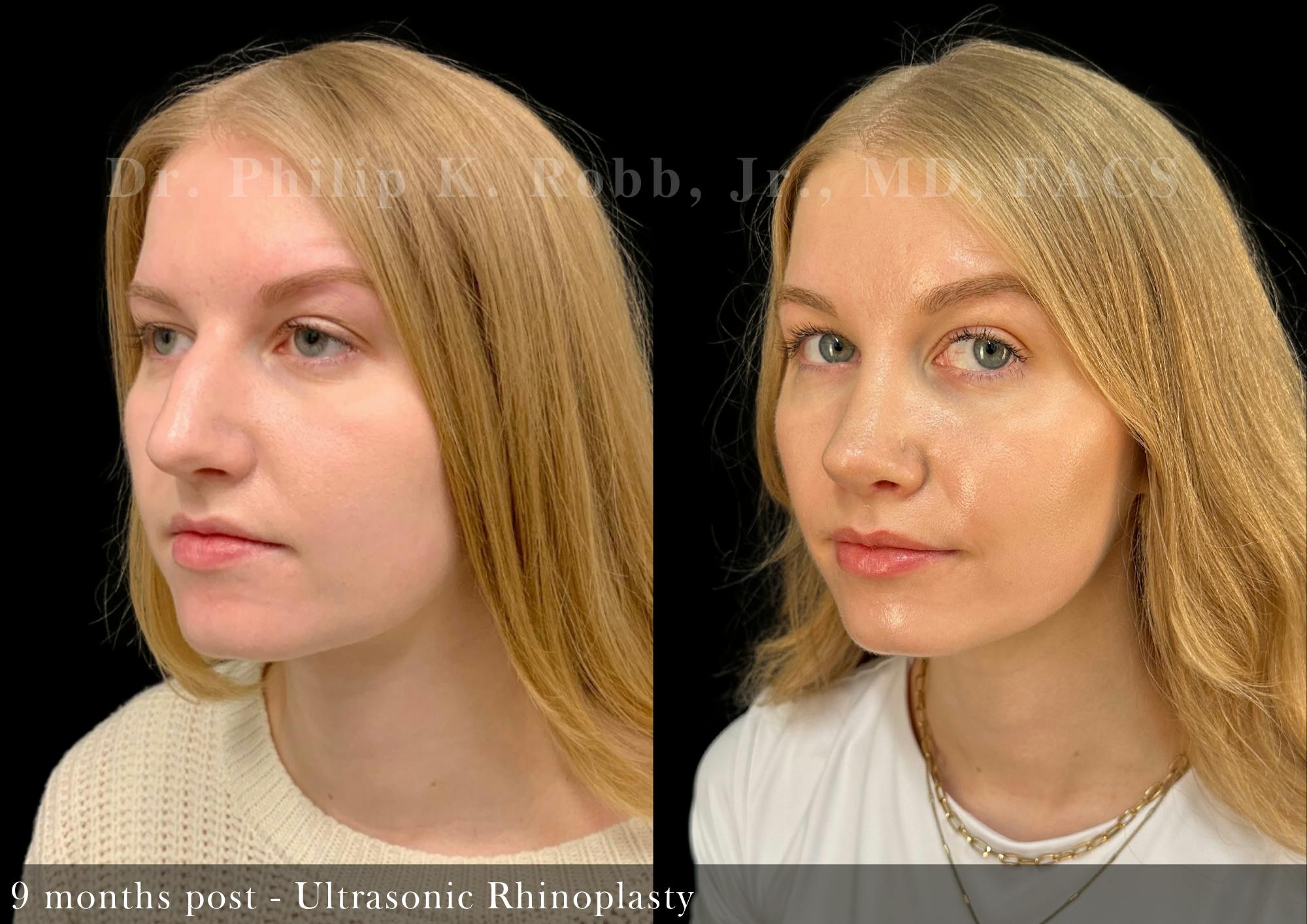 Nose Before & After Gallery - Patient 206656652 - Image 5