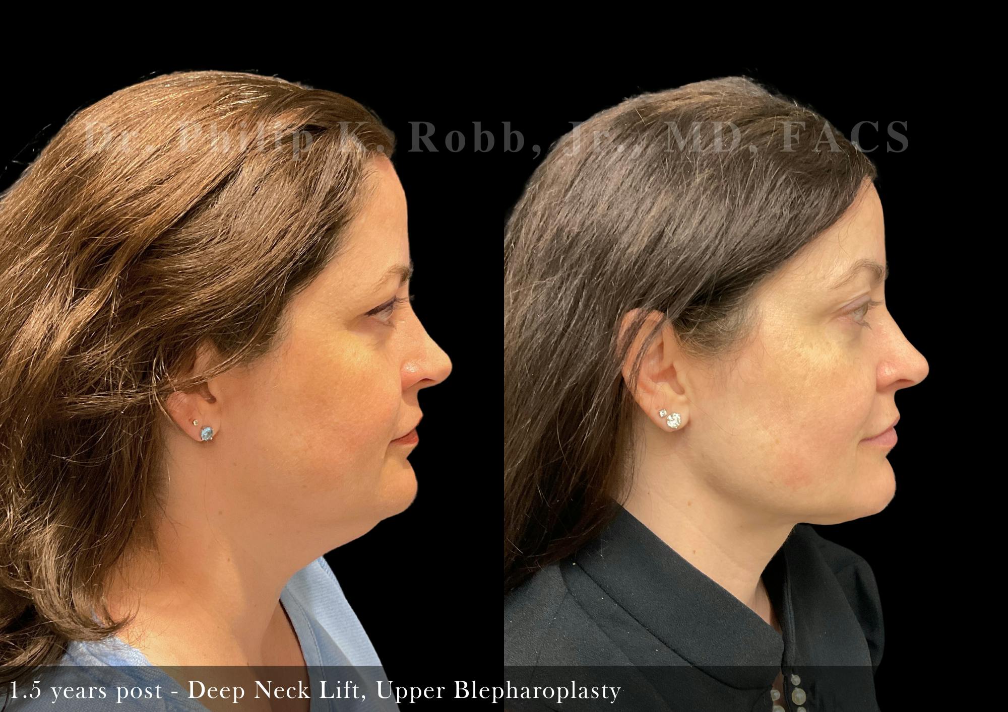 Face Before & After Gallery - Patient 206653326 - Image 3