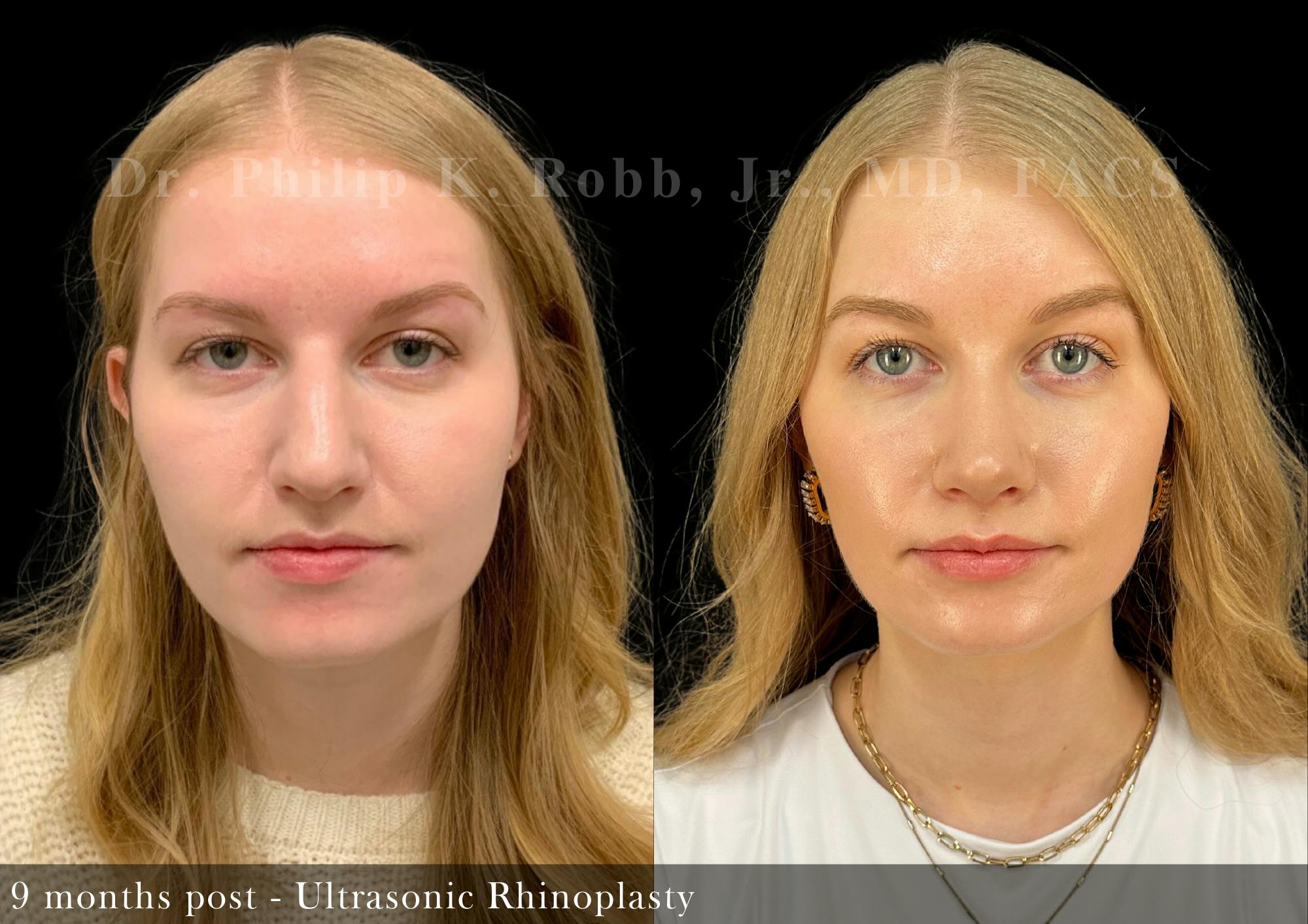 Nose Before & After Gallery - Patient 206656652 - Image 3