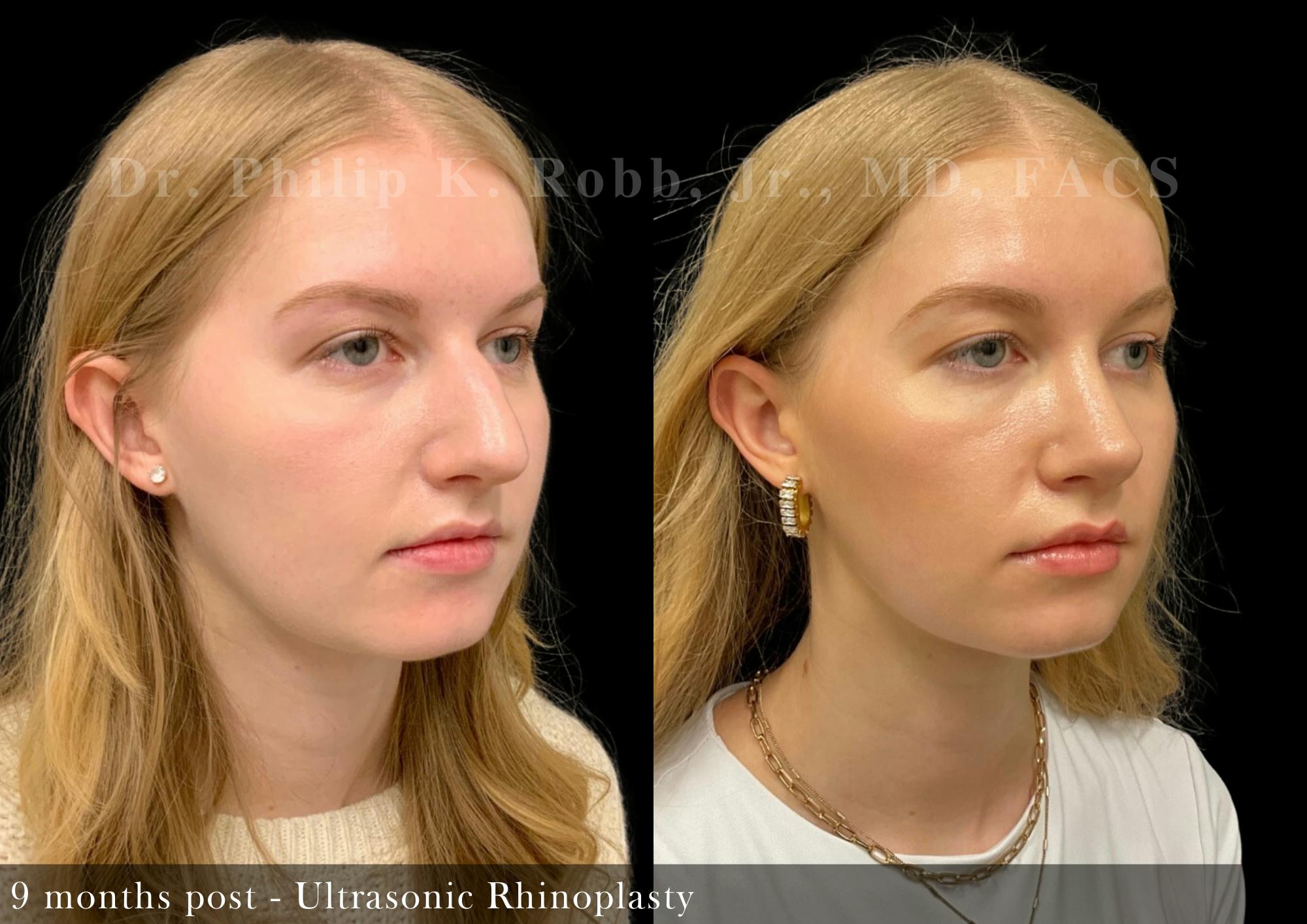 Nose Before & After Gallery - Patient 206656652 - Image 2