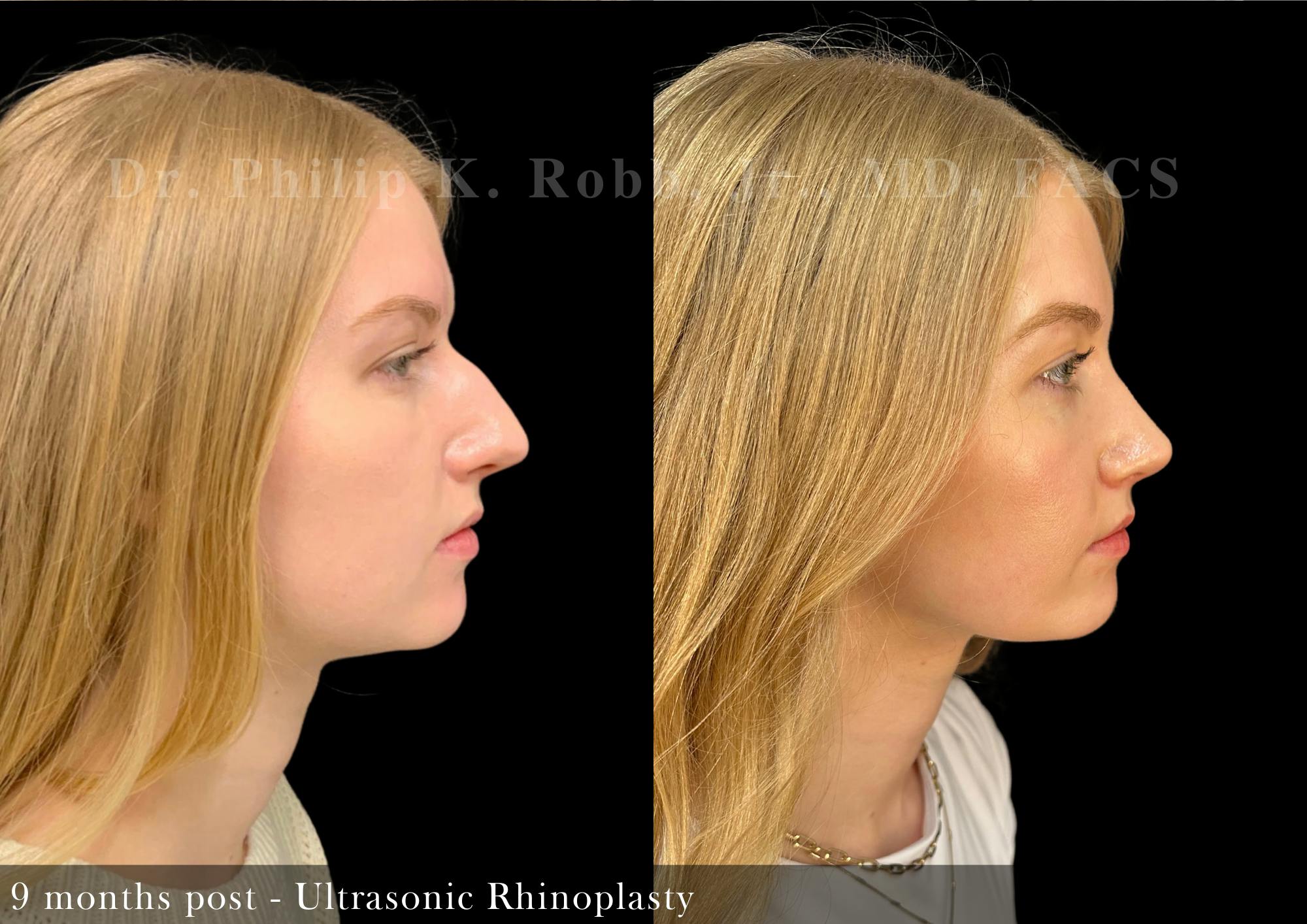 Nose Before & After Gallery - Patient 206656652 - Image 1