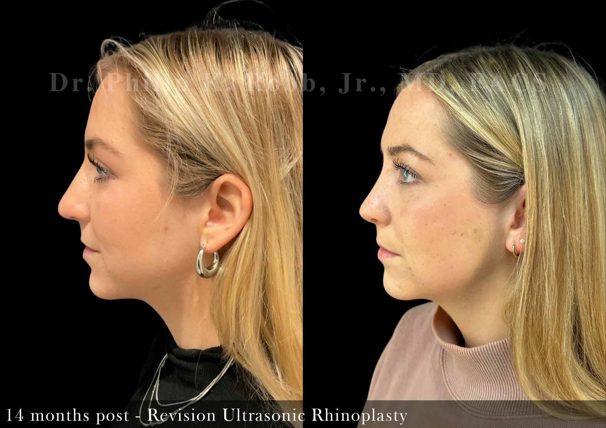 Nose Before & After Gallery - Patient 206656657 - Image 4