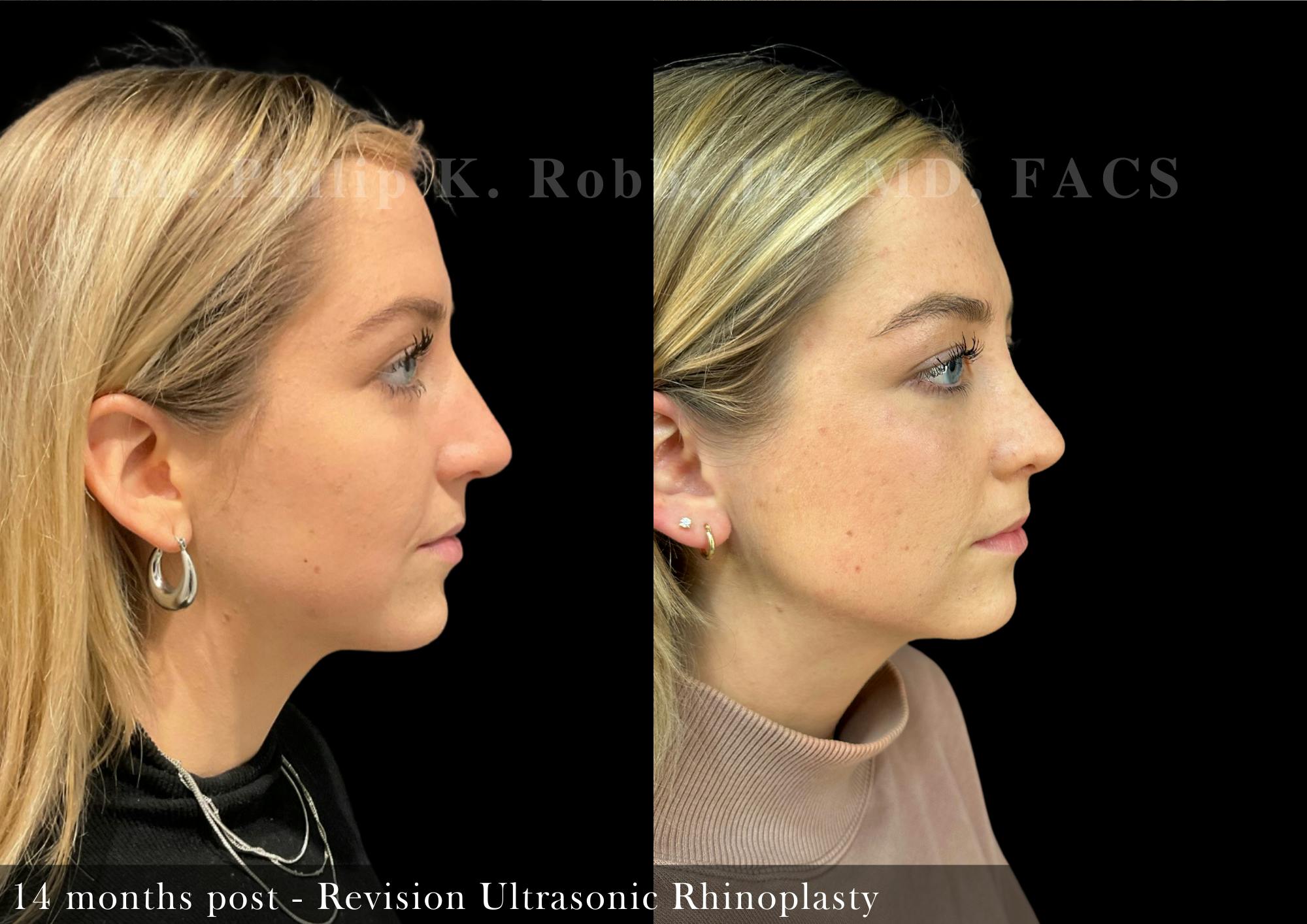 Nose Before & After Gallery - Patient 206656657 - Image 1