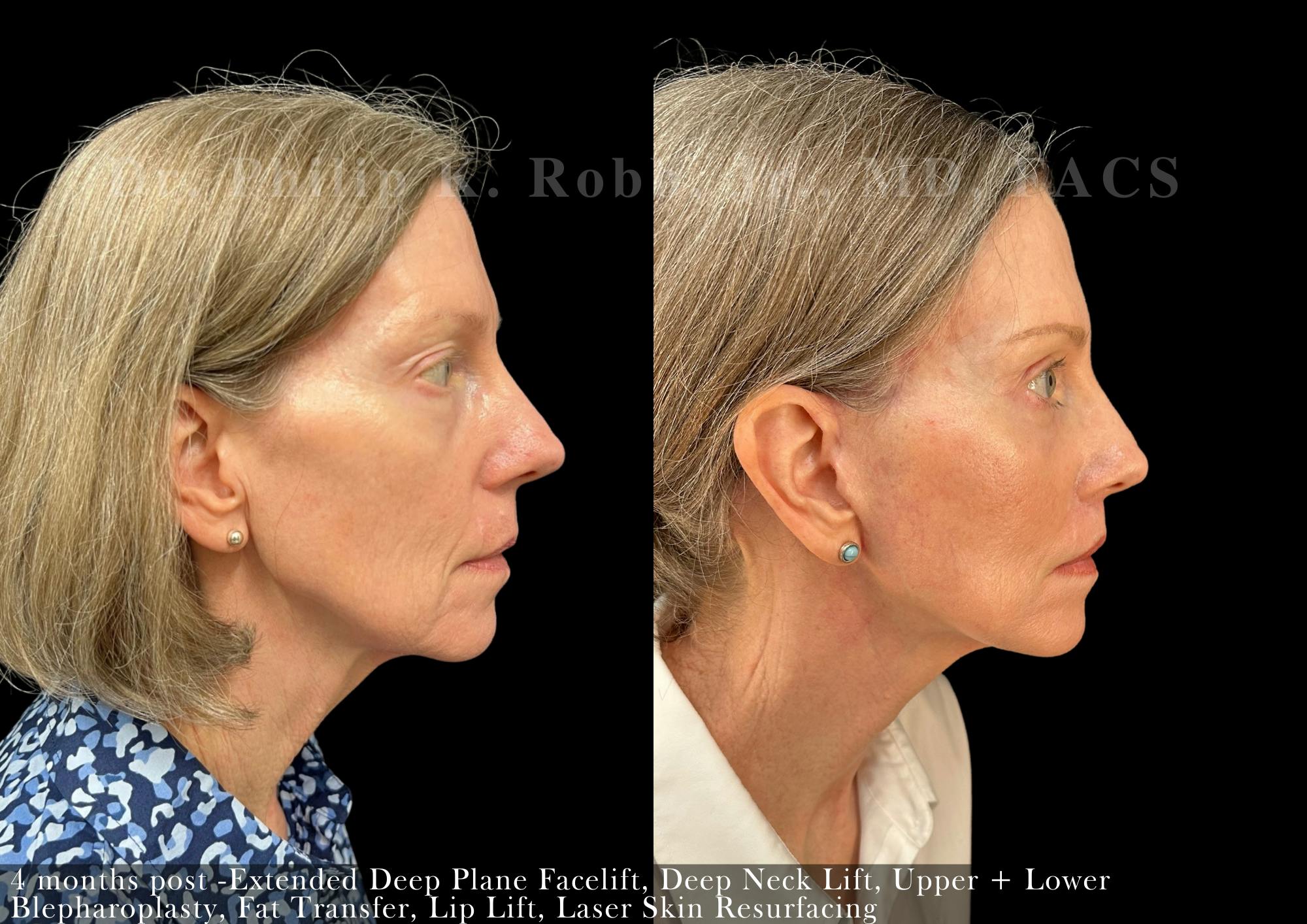 Face Before & After Gallery - Patient 206656616 - Image 3