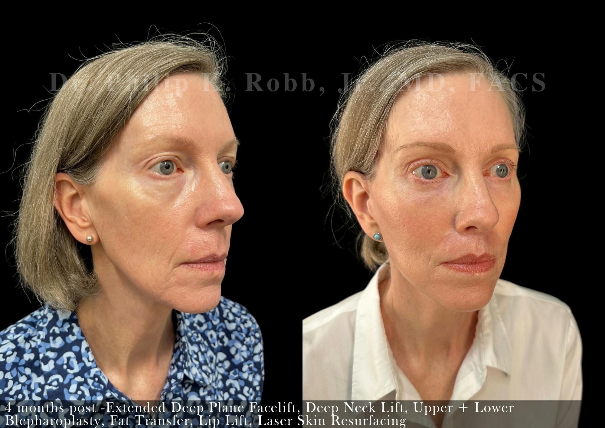 Face Before & After Gallery - Patient 206656616 - Image 2