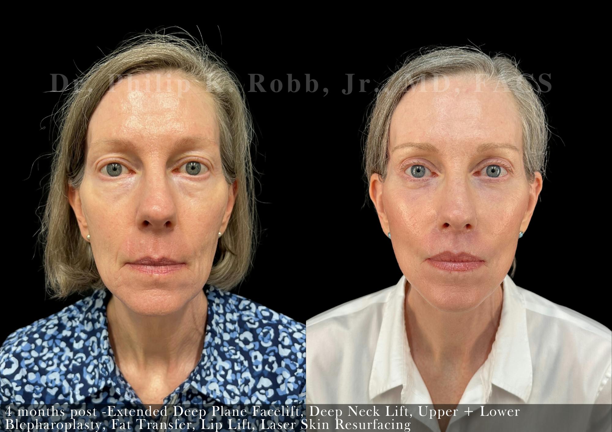 Face Before & After Gallery - Patient 206656616 - Image 1